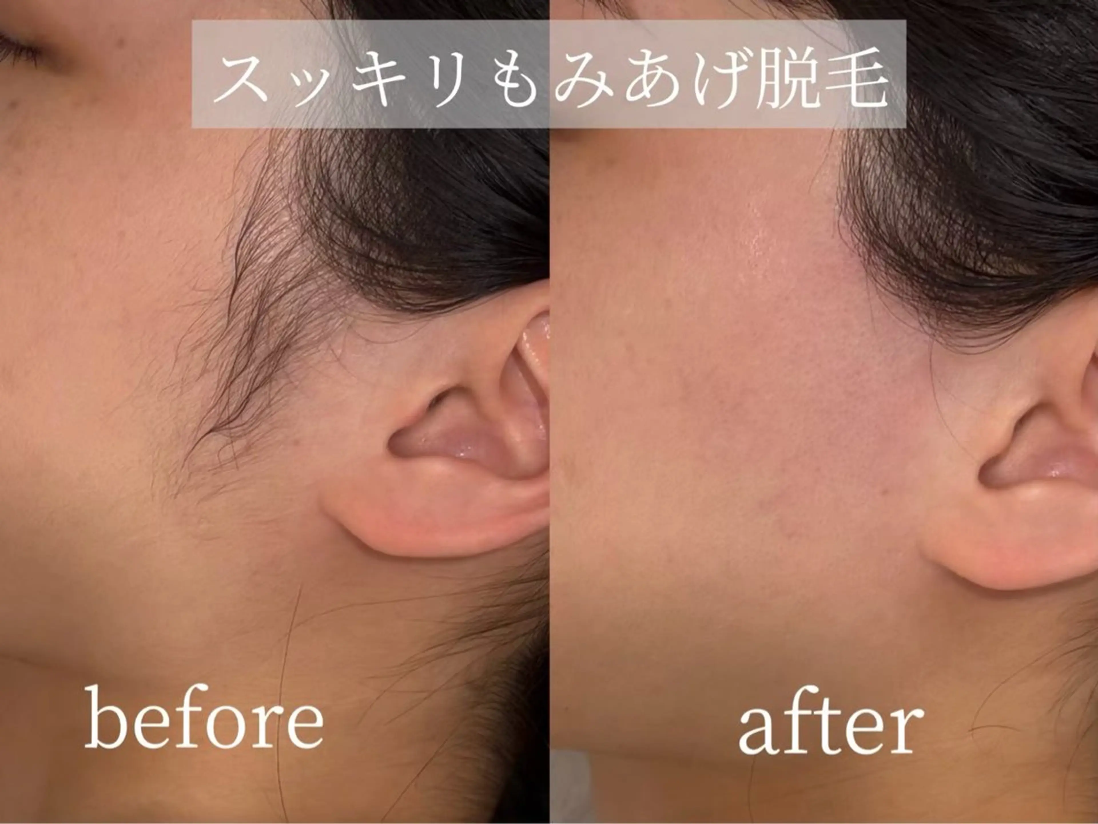 【圧倒的つるん肌】フルフェイスWAX+保湿パック付き(利用条件:女性限定/眉以外のお顔waxご希望の方)の写真