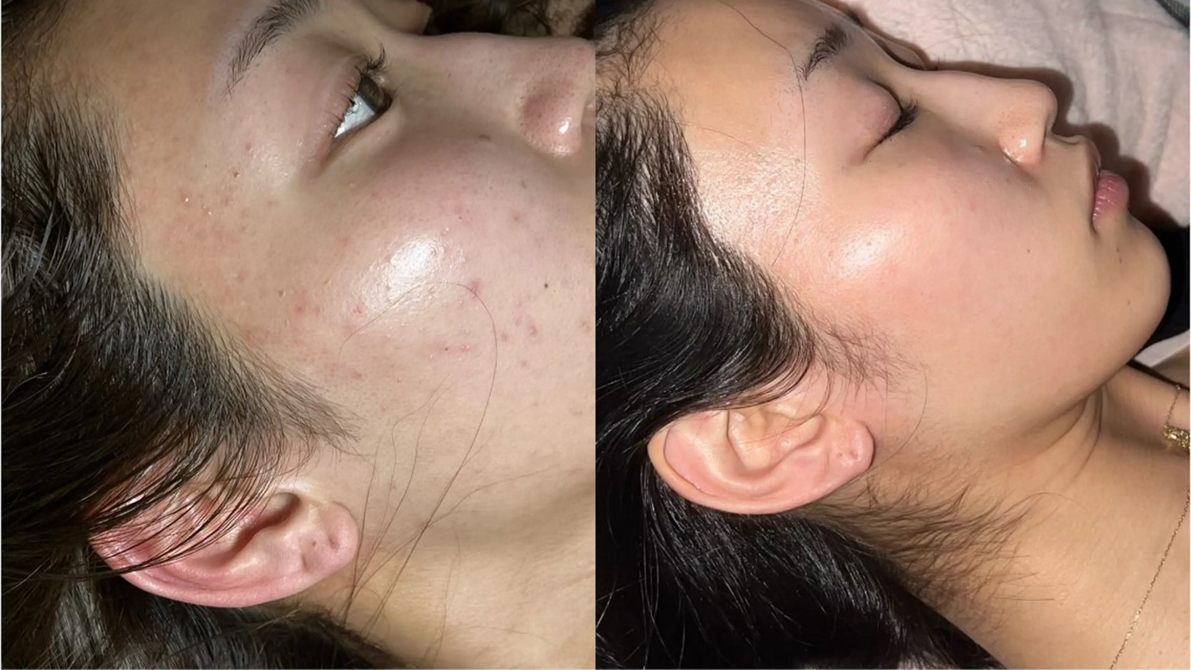 ハイドロ毛穴洗浄の写真