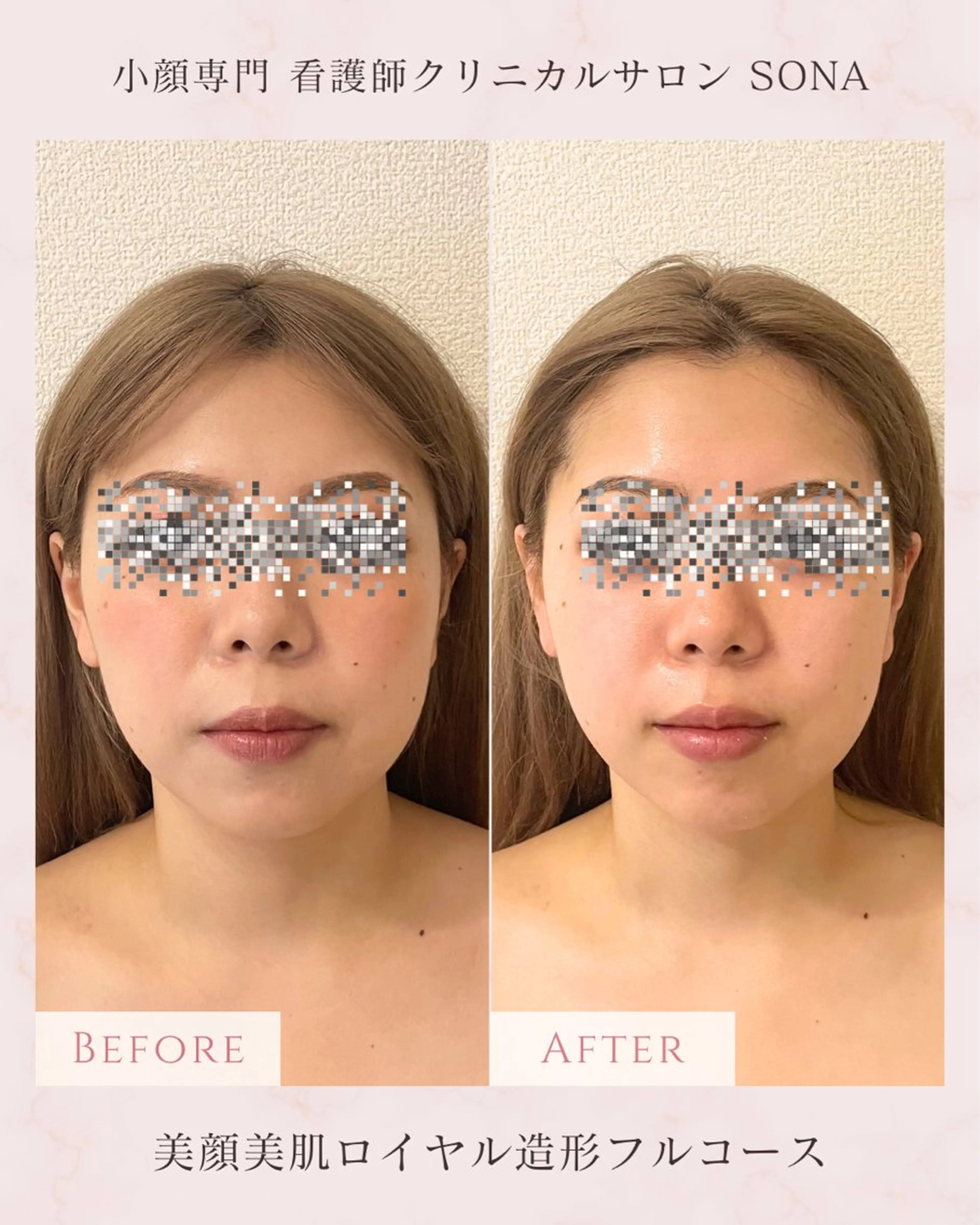 エステ 【小顔痩身専門看護師 サロンSONA】のエステ・リラクイメージ