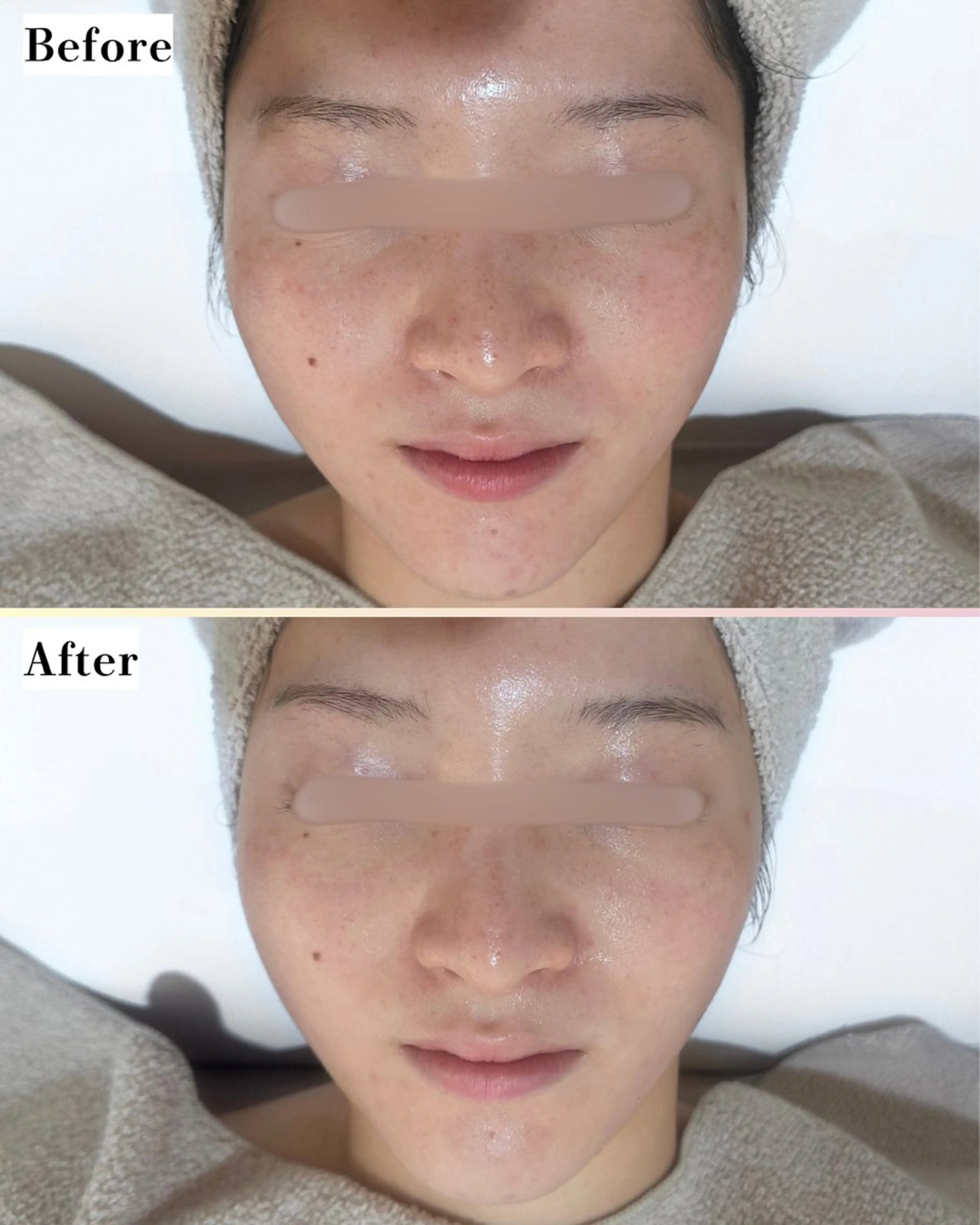 エステ |ピーリング・毛穴| soina神楽坂のエステ・リラクイメージ