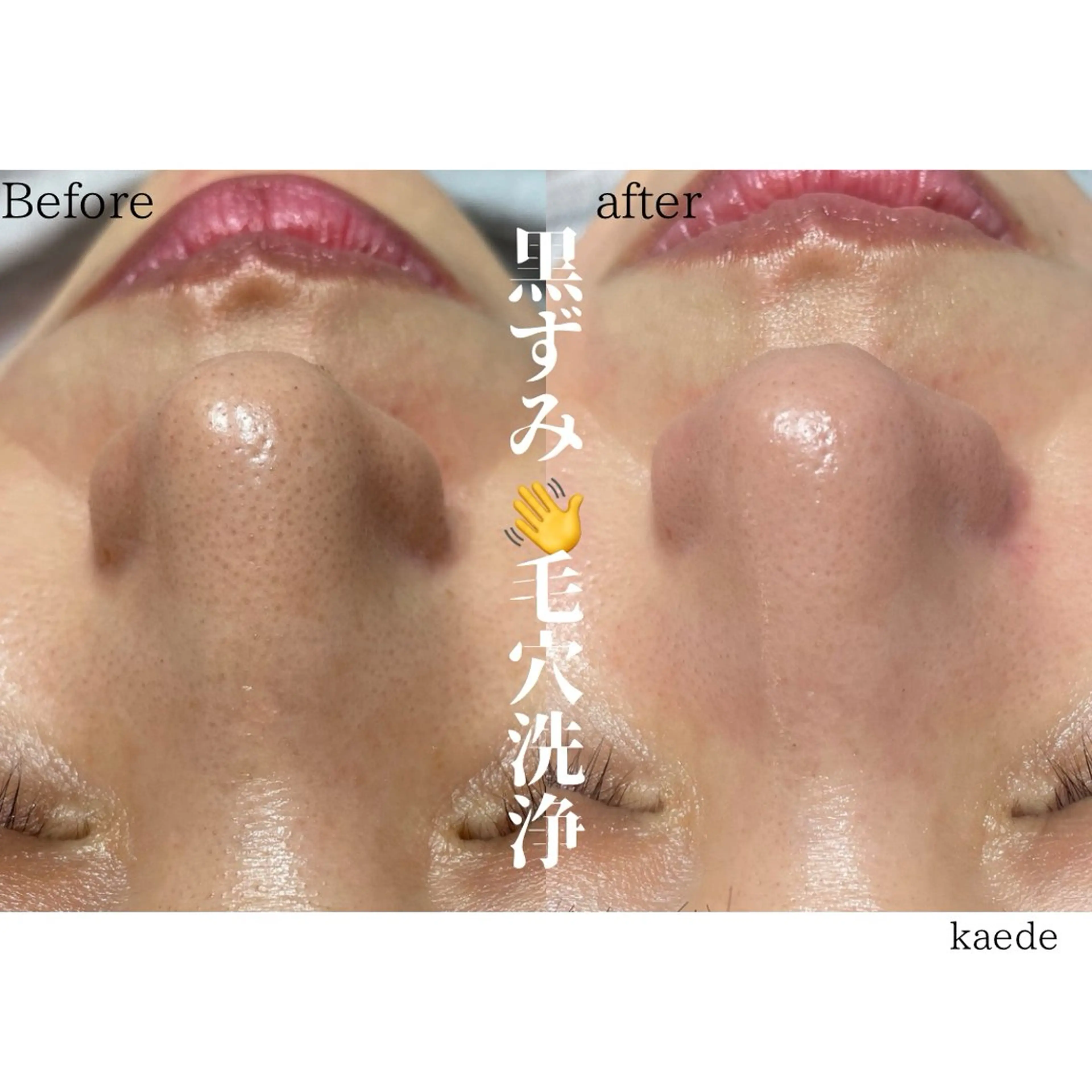 エステ 🎀kaede🎀 骨格似合わせ眉毛の眉毛・アイブロウイメージ