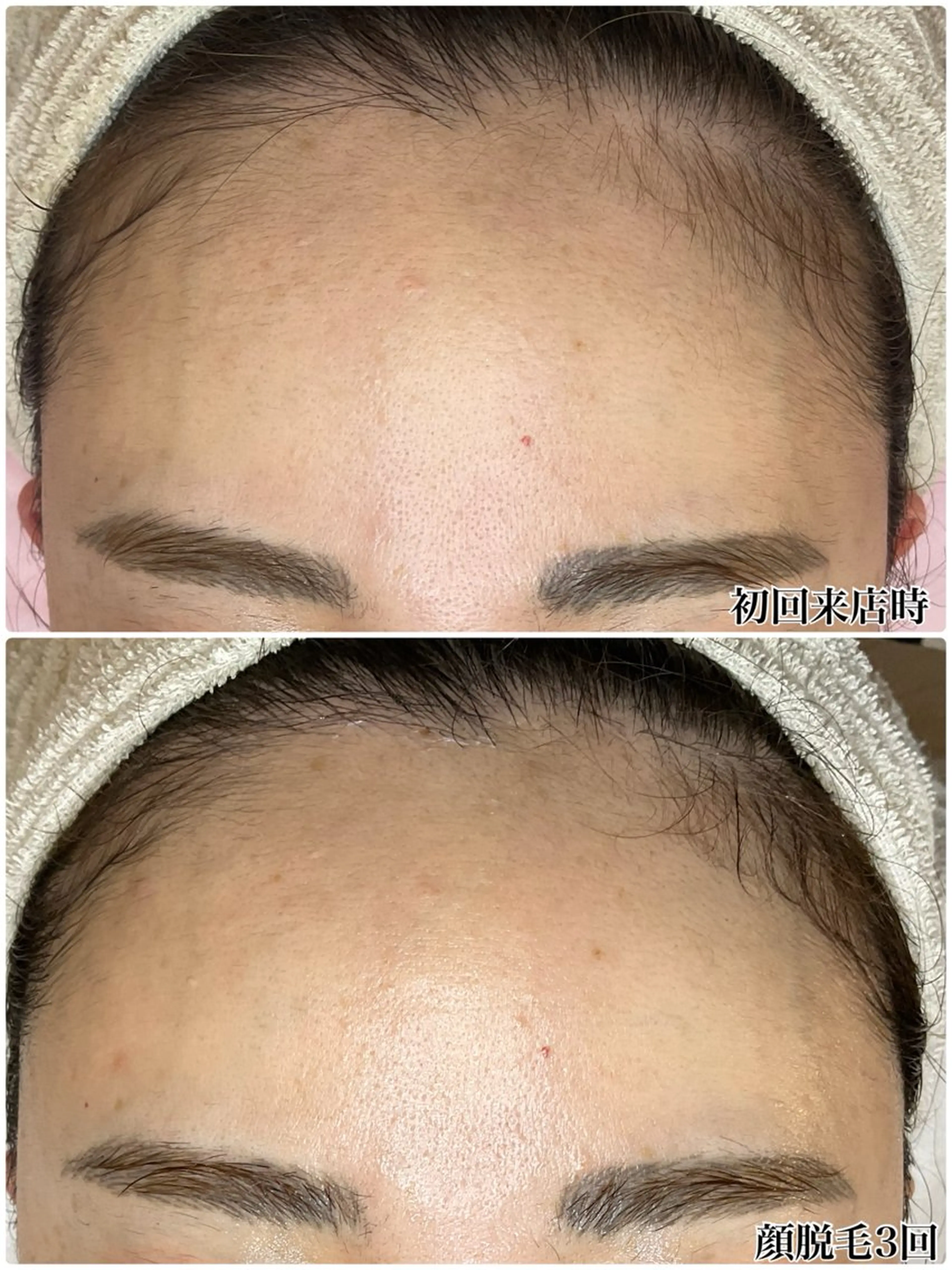 透明感🆙お顔コラーゲン脱毛１回の写真