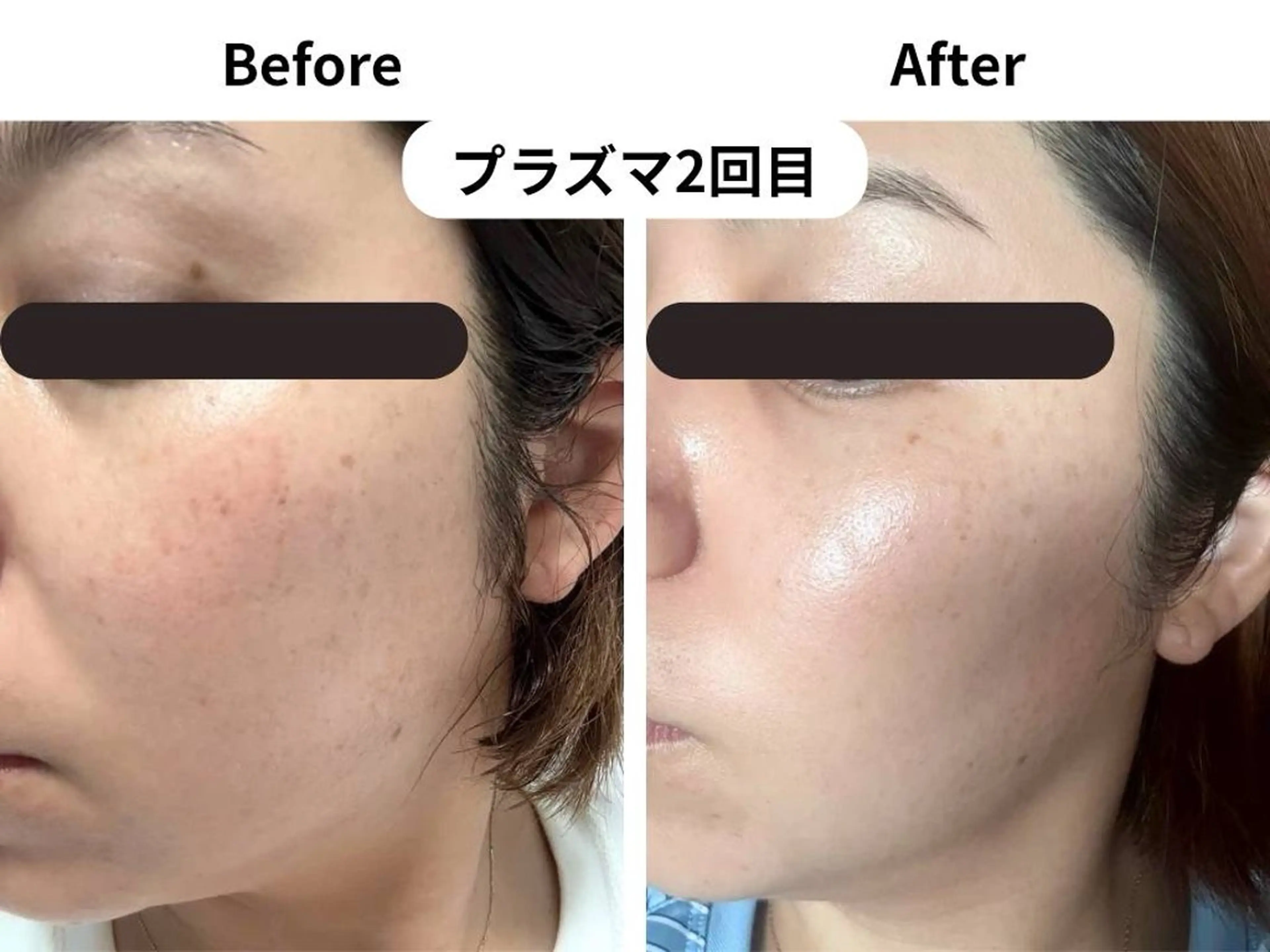 【最先端のシワくすみ改善】ライトニングプラズマ ¥15,000→¥8800の写真