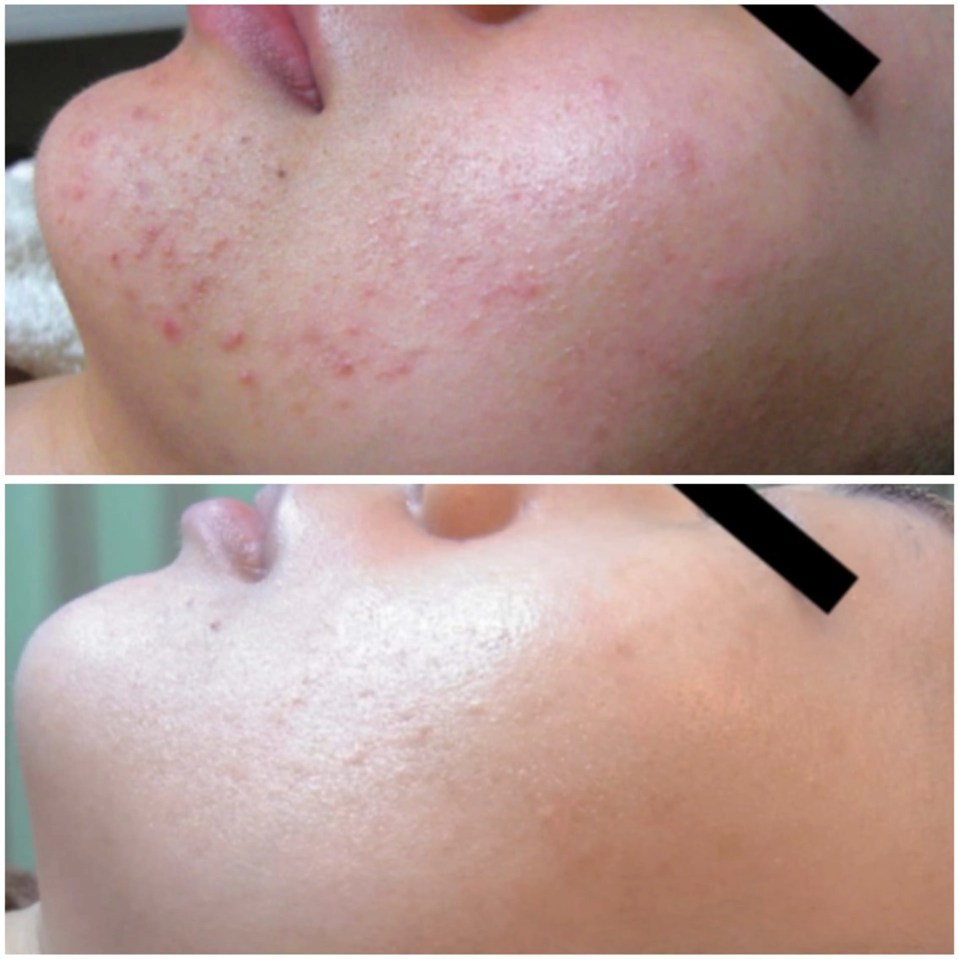 【肌質改善特化】エクスビアンス水光ピール✨毛穴レス艶肌/初回¥6,600の写真