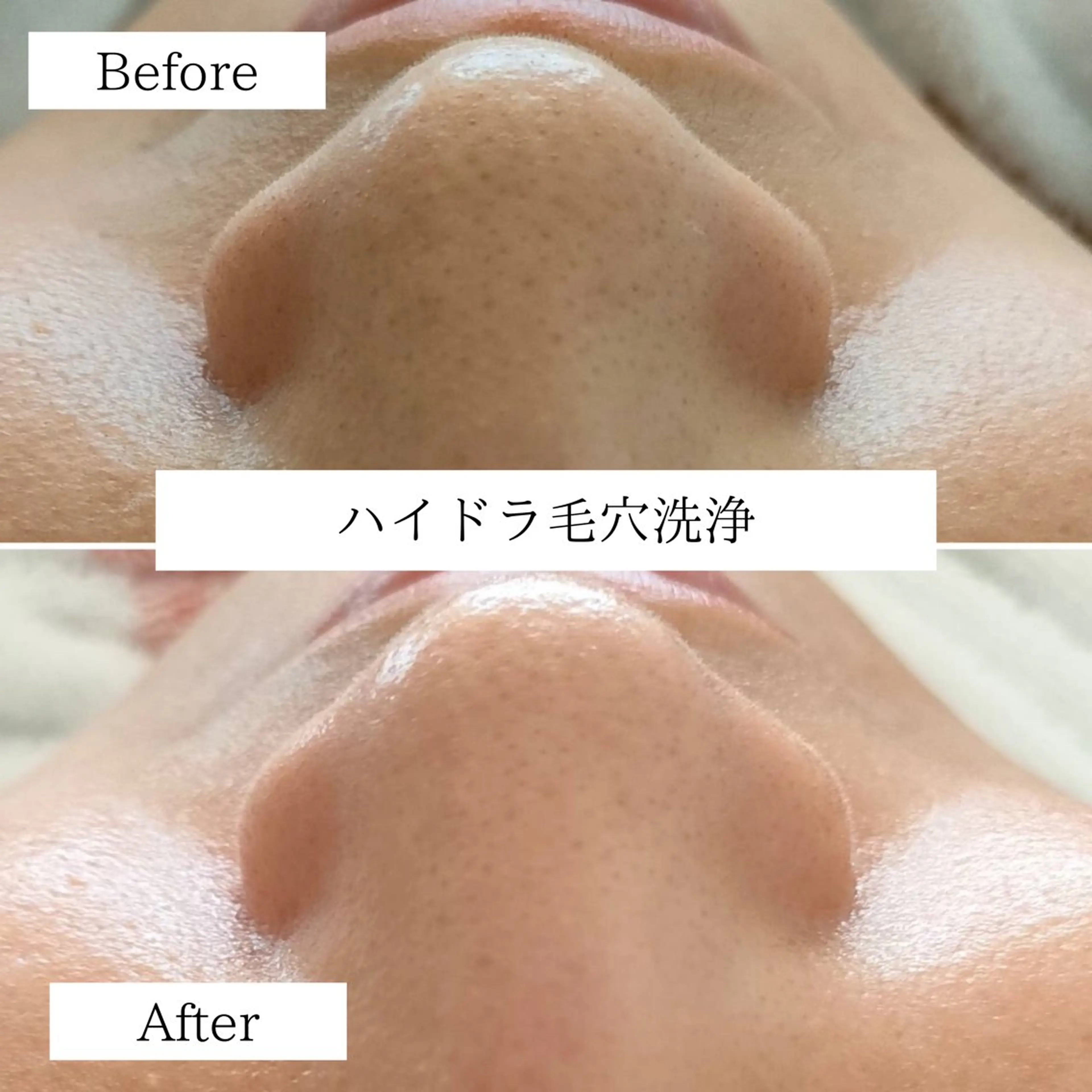 ハイドラ毛穴洗浄の写真