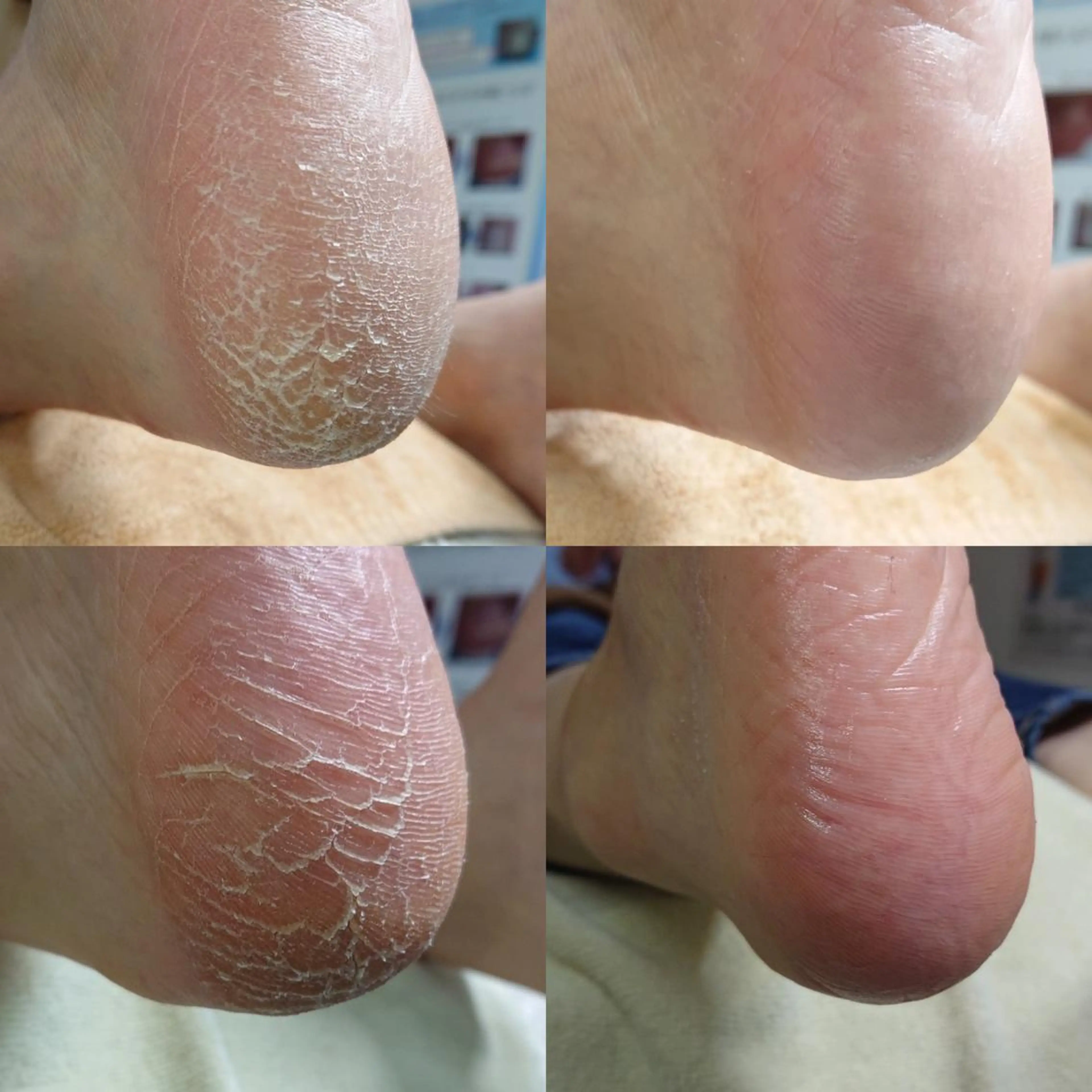 【カカトケア】朗報✨【🉐2回目以降もずっと"施術料が500円🉐】ガサガサ角質もツルスベに✨✨仕上がり大満足💁‍♀️の写真