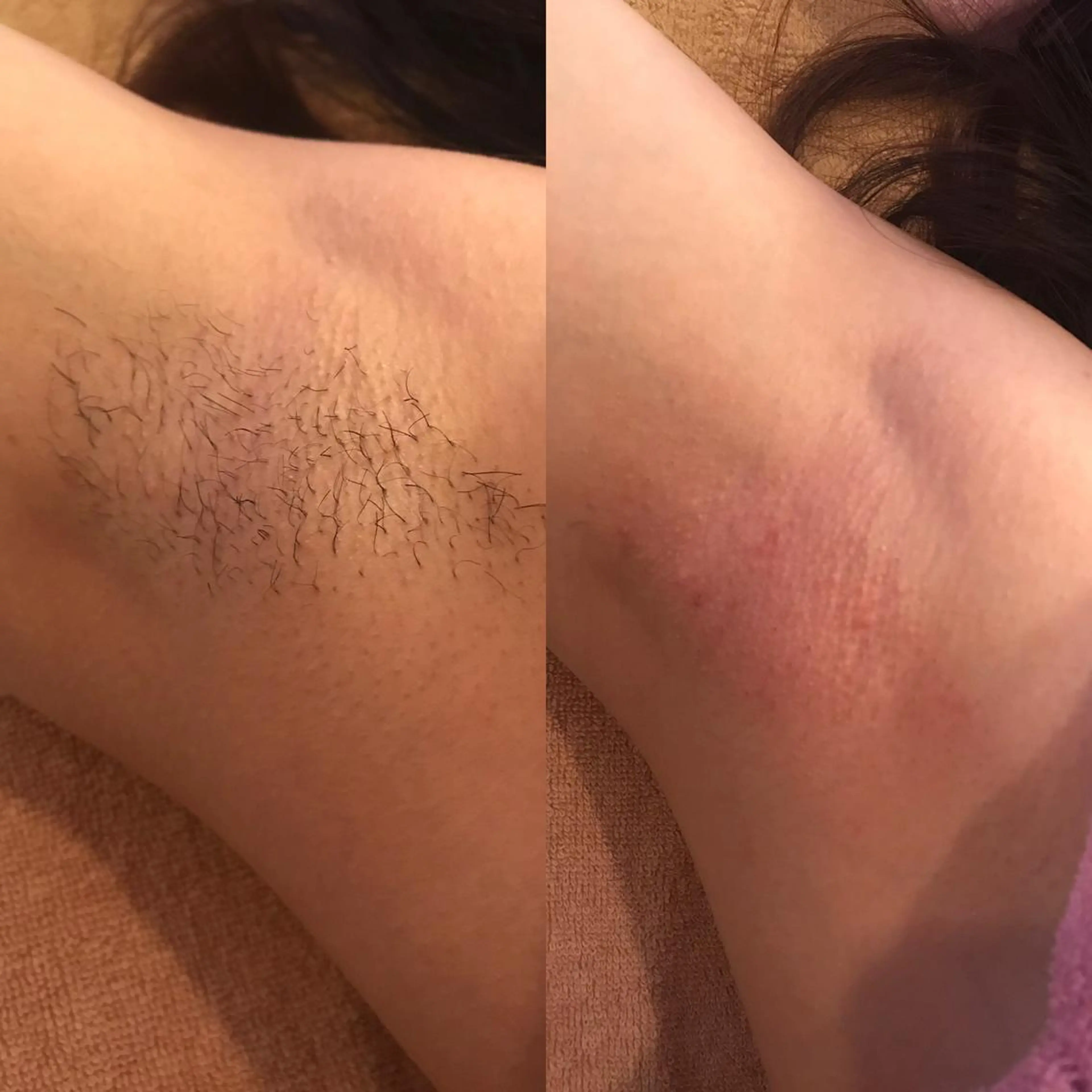 【黒ずみ対策期待◉】ワックス脱毛 両脇 ＋ 保湿ジェル付きの写真