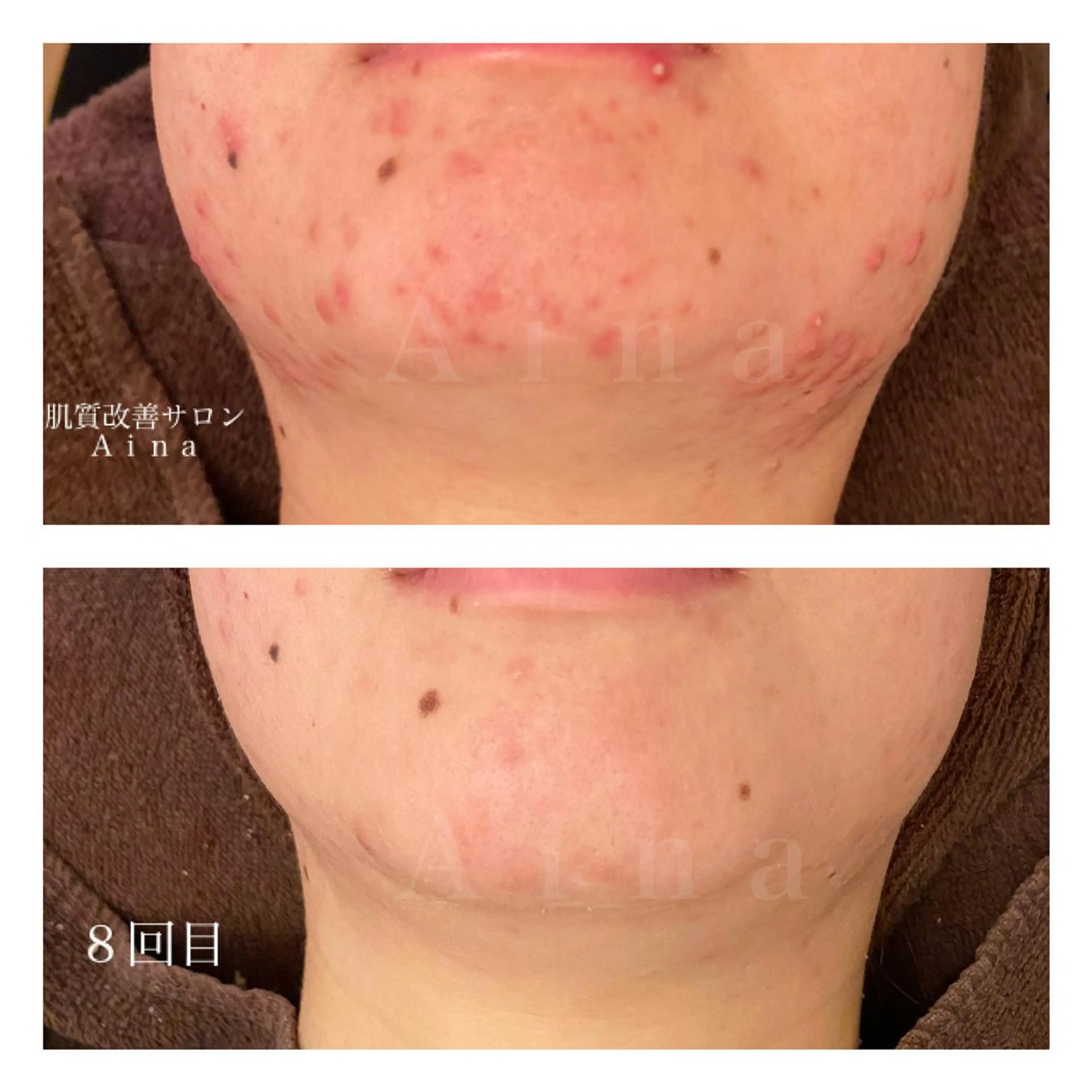 セミロング カラー パーマ ヘアアレンジ メンズ キッズ ネイル マツエク・マツパ 赤色 エステ リラク ニキビ跡専門サロン Ａｉｎａのエステ・リラクイメージ