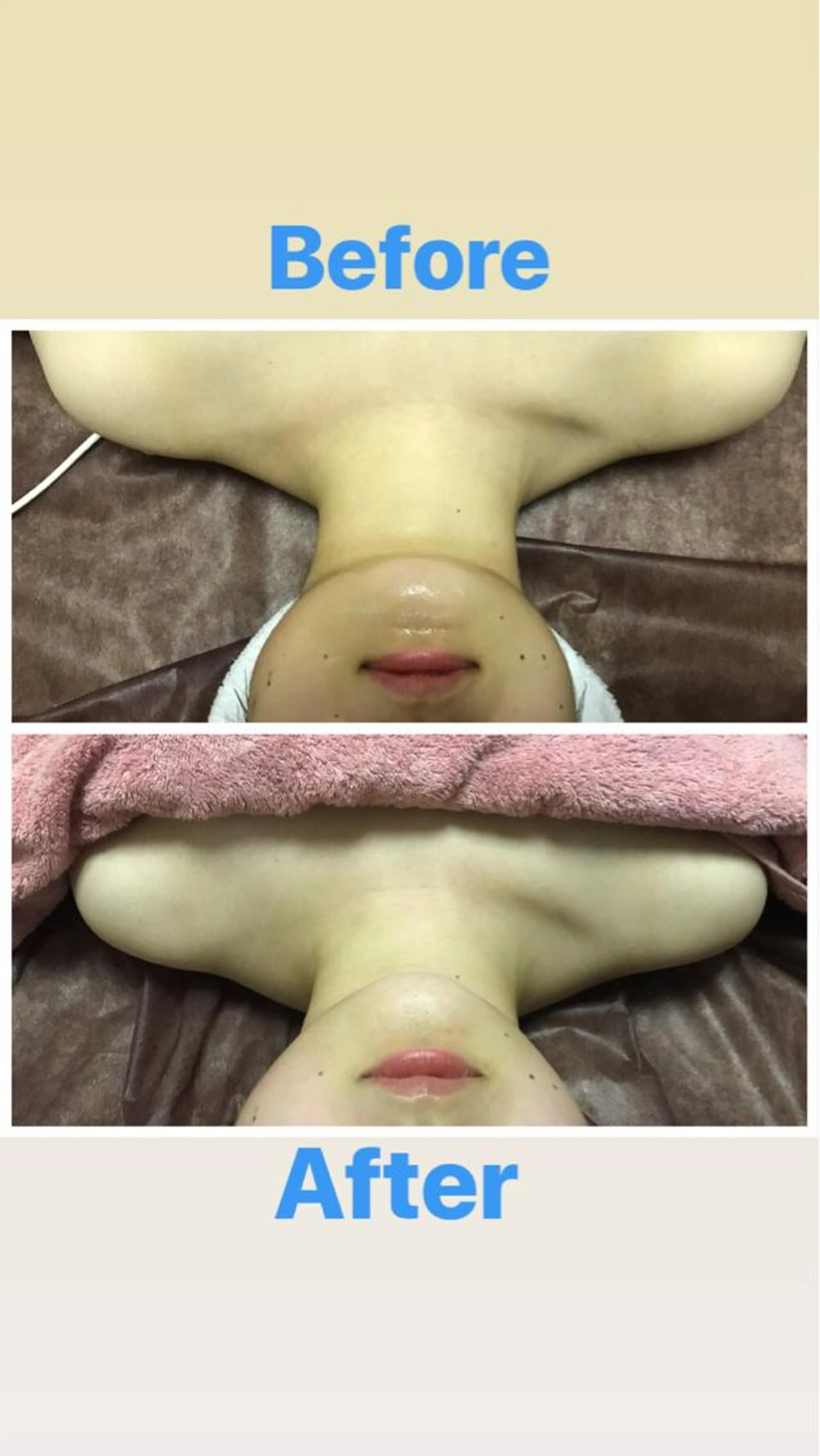 小顔60分お悩みに合わせてラジオ波、ハンドマッサージで施術をします。の写真