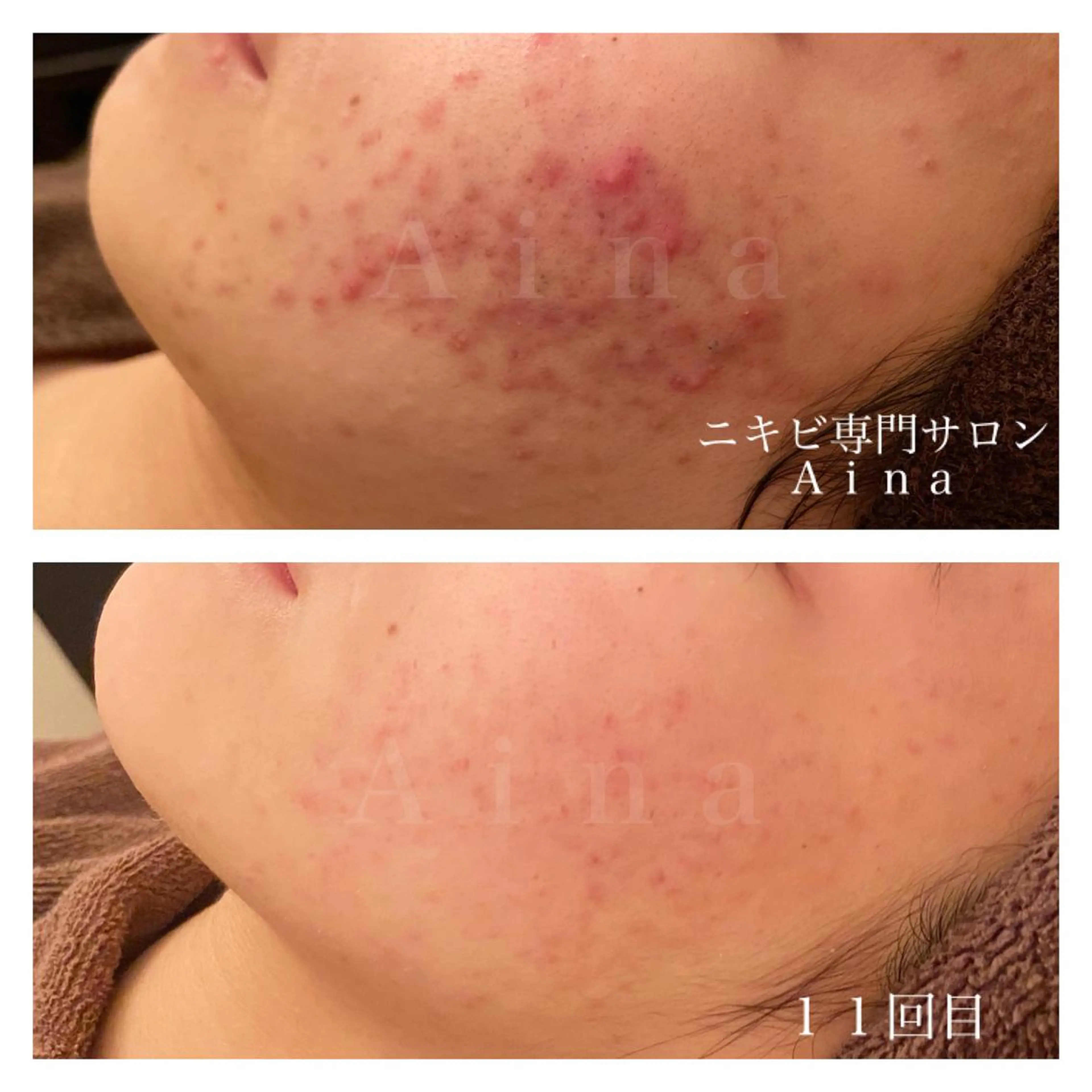 【ニキビ・ニキビ跡】徹底ケアコース　デコルテトリートメント付きの写真