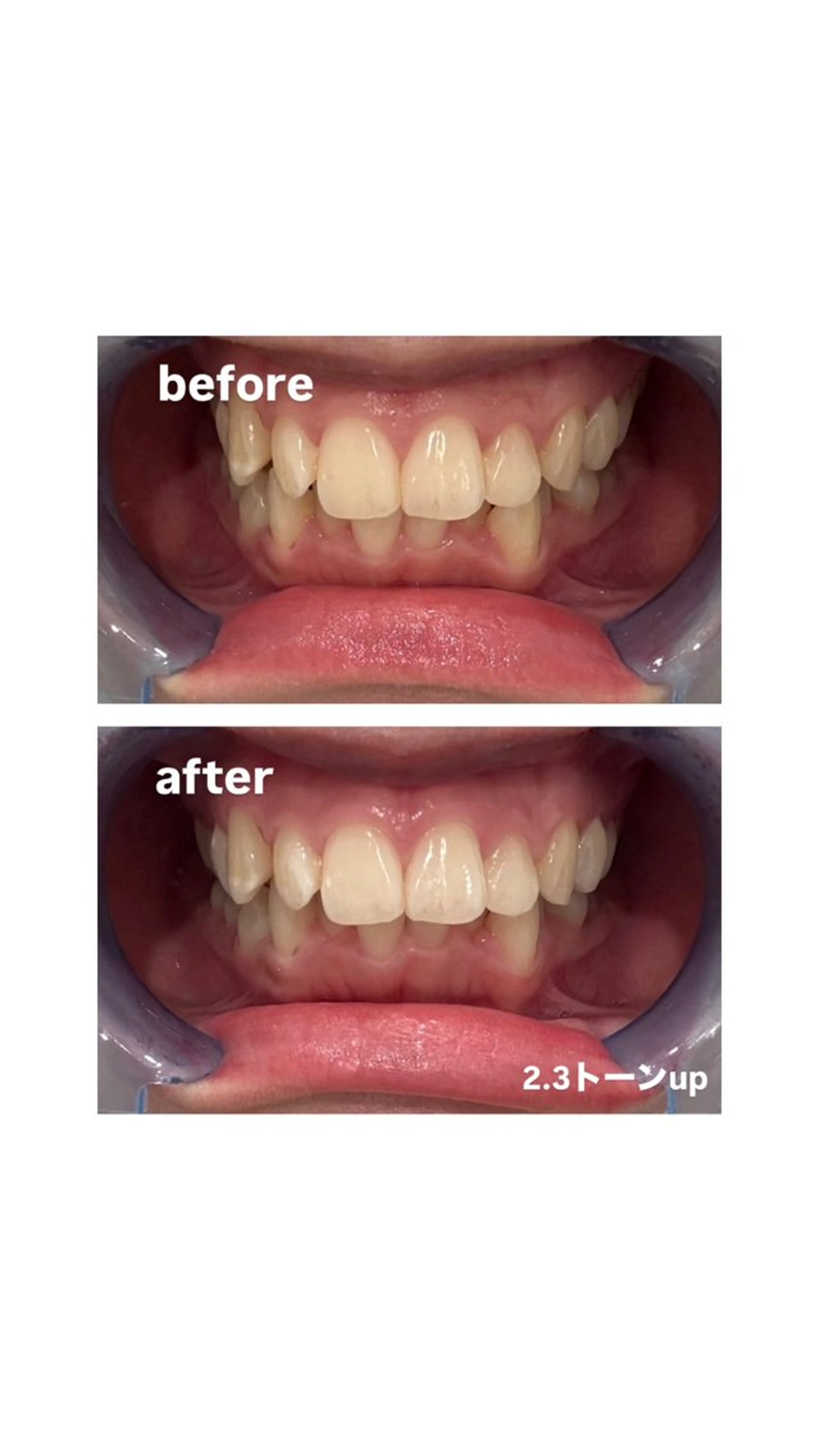 歯のホワイトニング10分×2回　3回回数券の写真