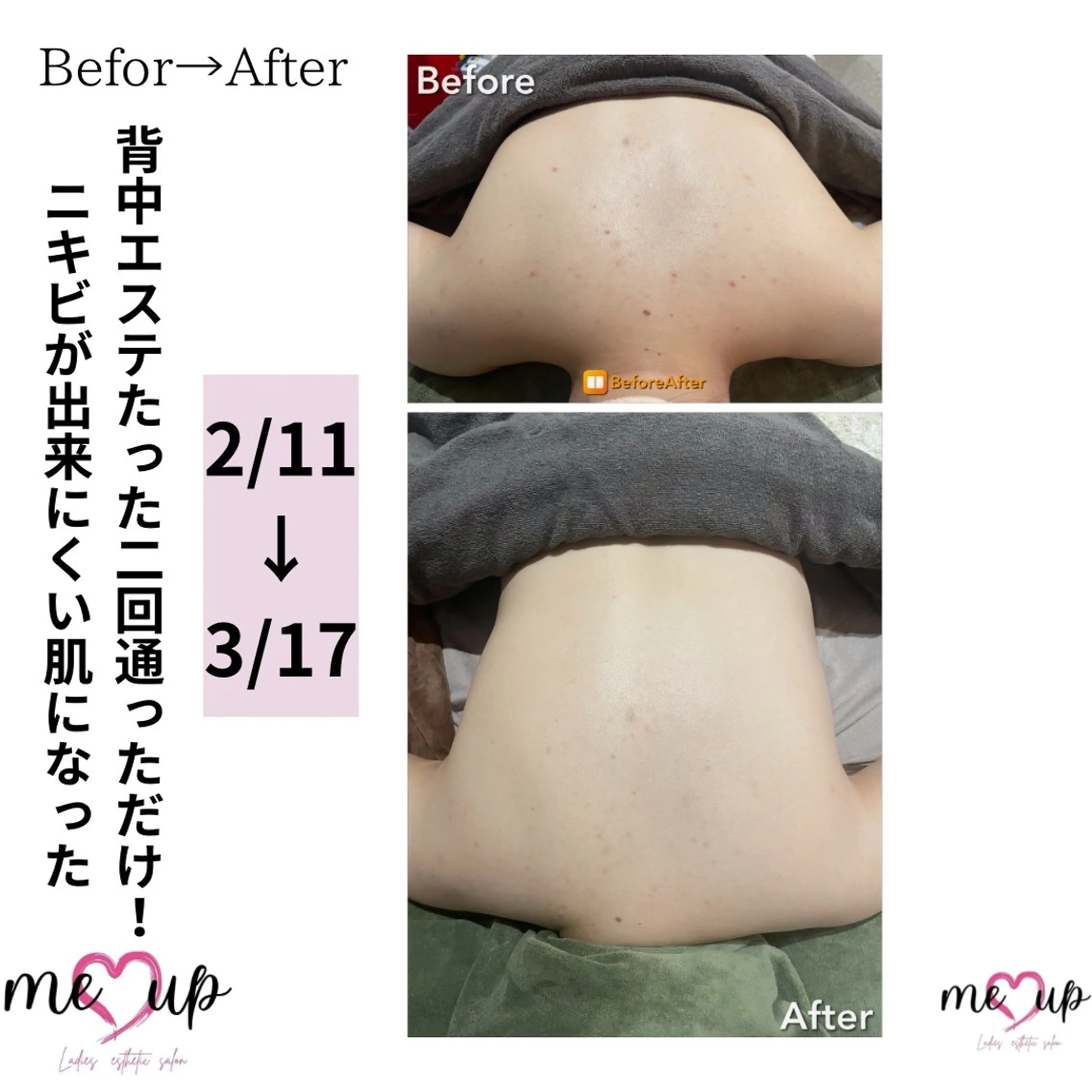 エステ Meupニキビ専門店 背中/ハーブ/肌管理のその他イメージ