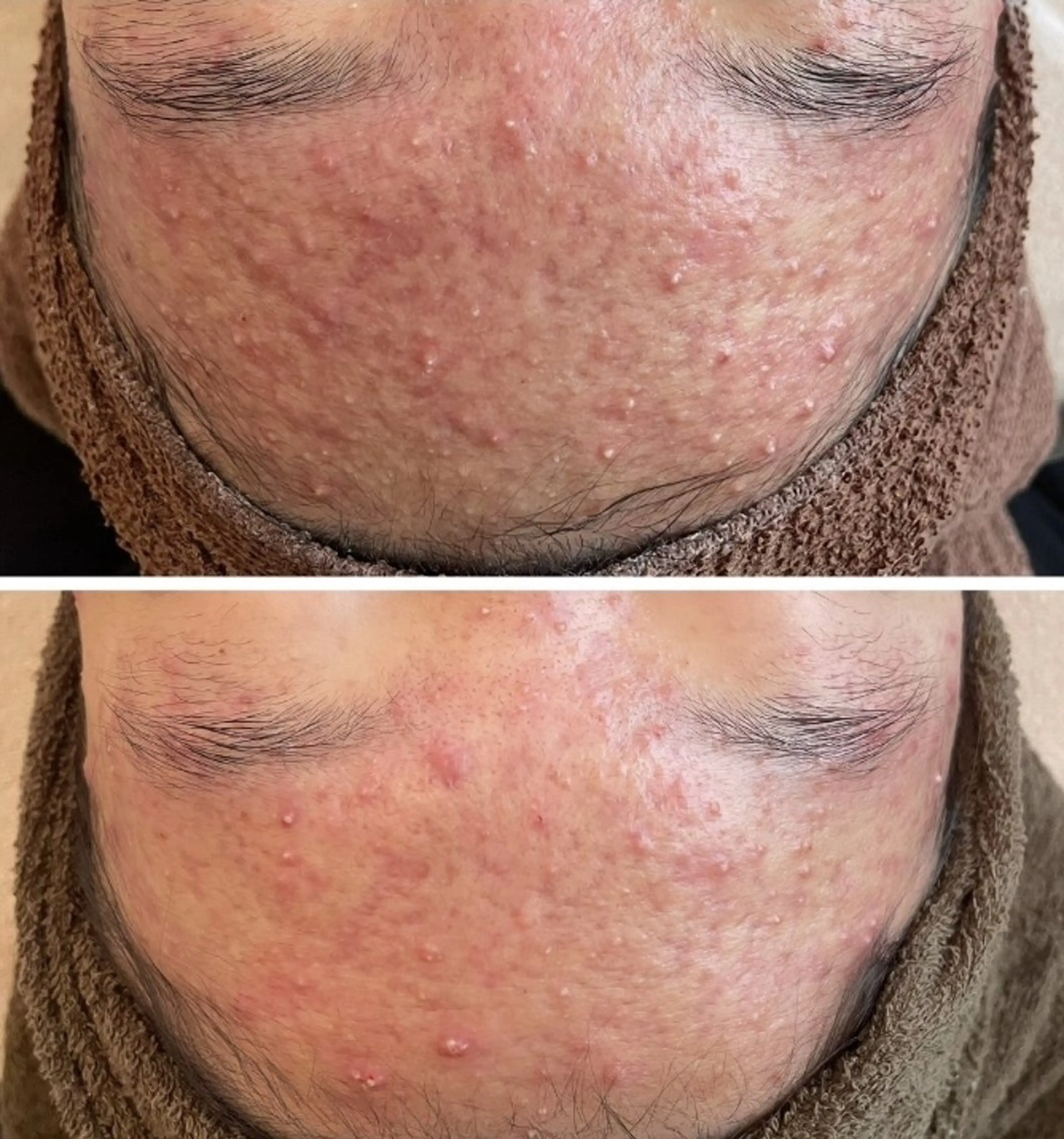 漢方ハーブピーリング（バランスリペアコース）の写真