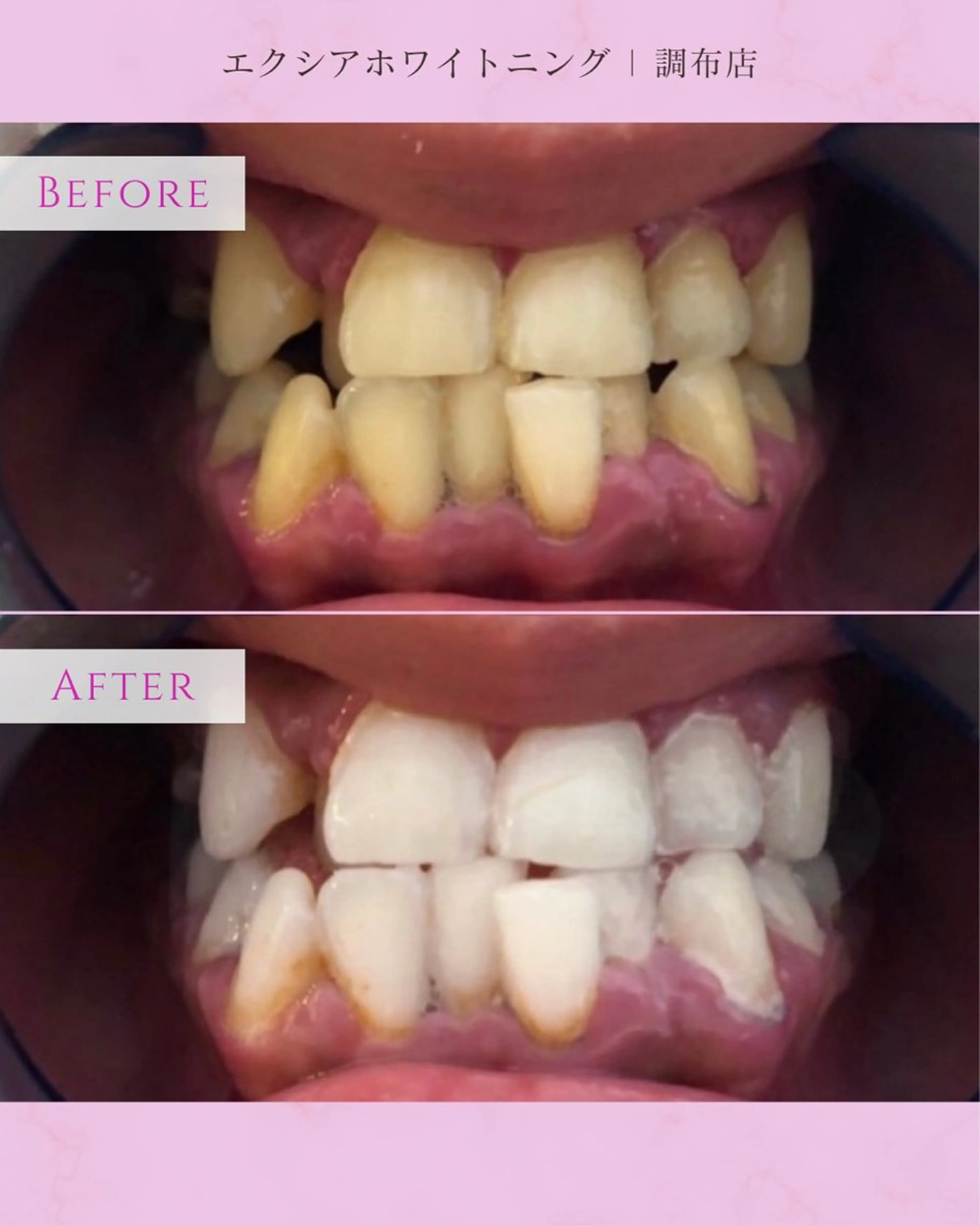 エクシアホワイト調布所属・yumi❤︎ ホワイトニングのその他イメージ