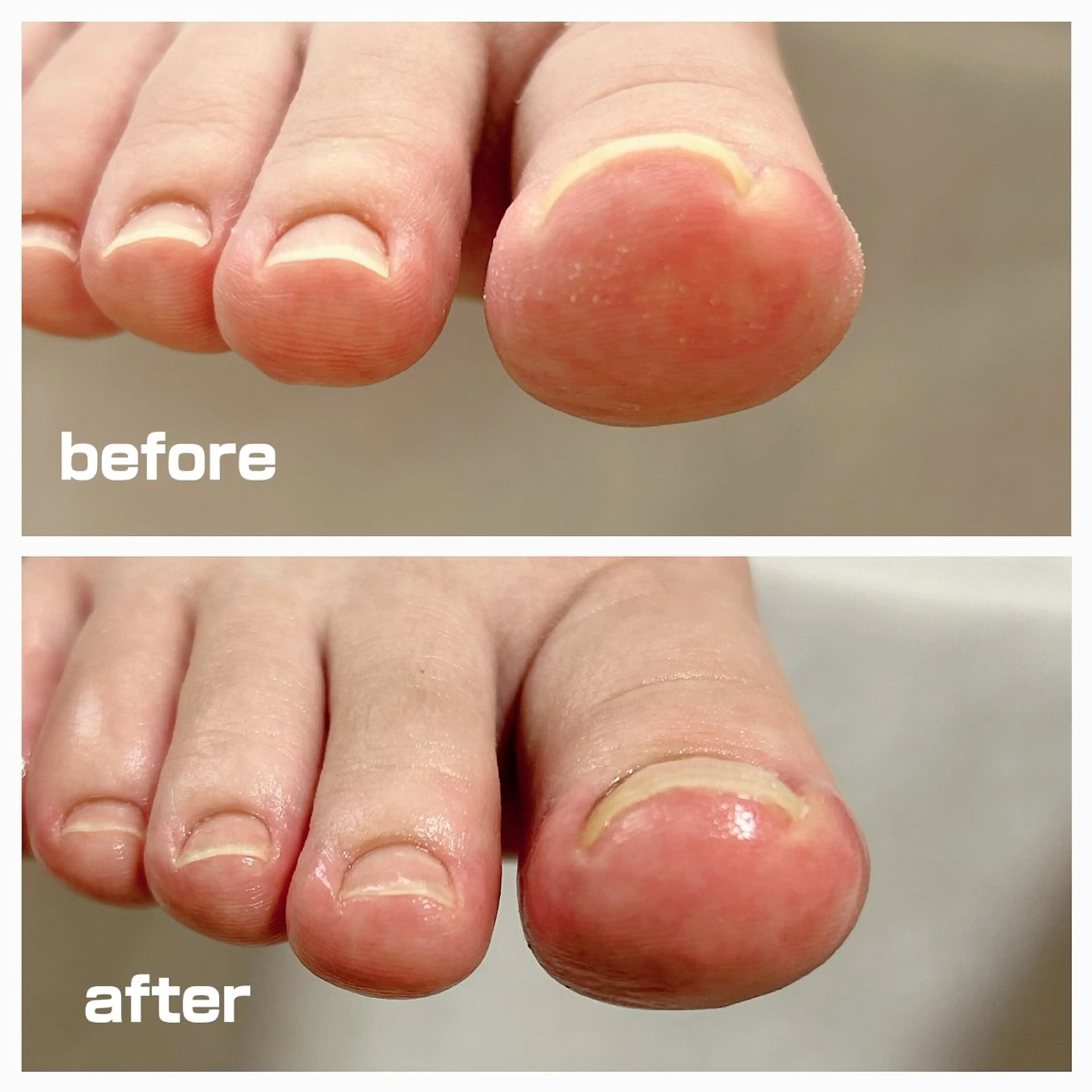 その他 巻き爪フットケアサロンKotori所属・フットケアサロン Kotoriのその他イメージ