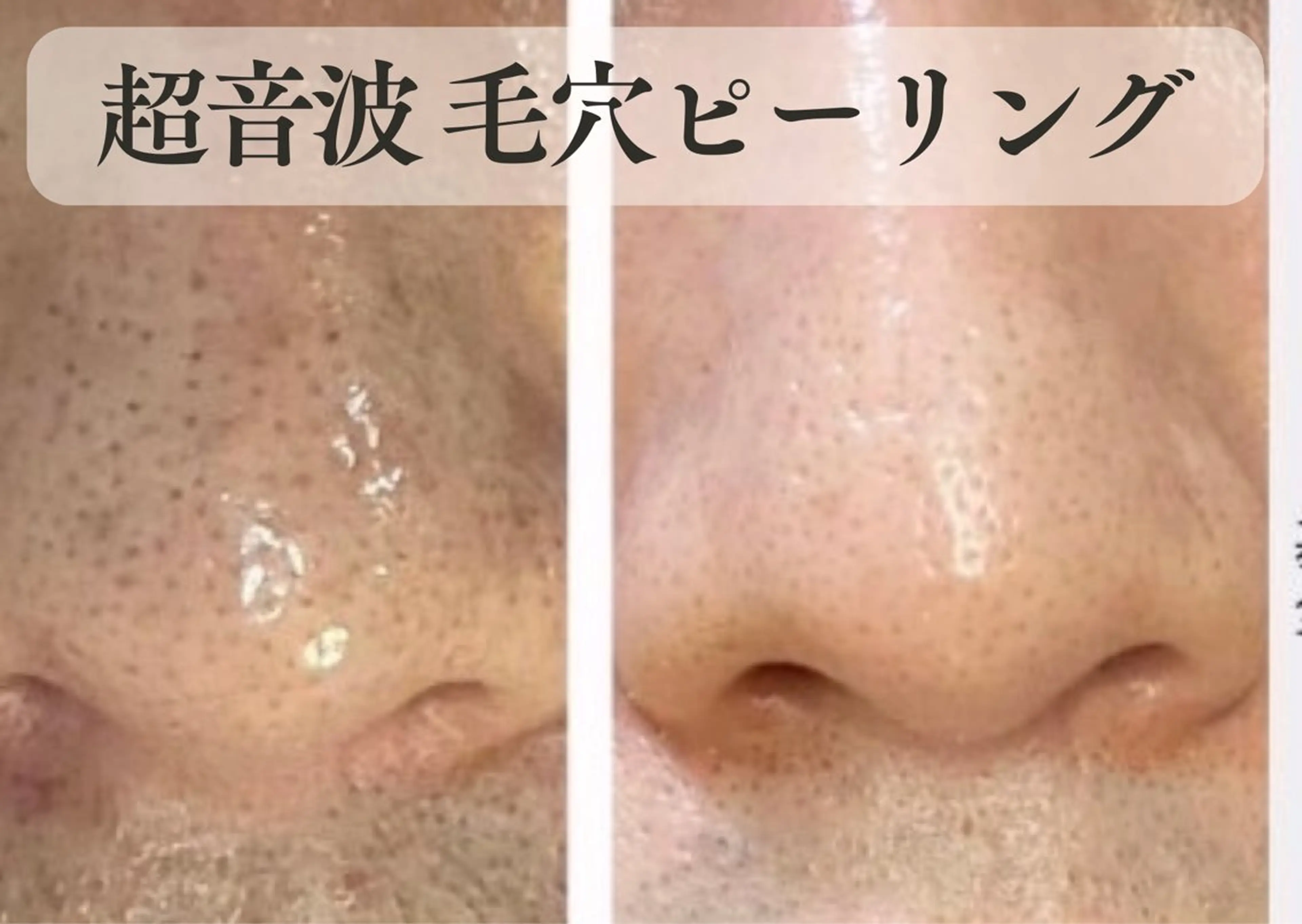 大人気メニュー！超音波毛穴ピーリングトライアル　8800円→4400円の写真