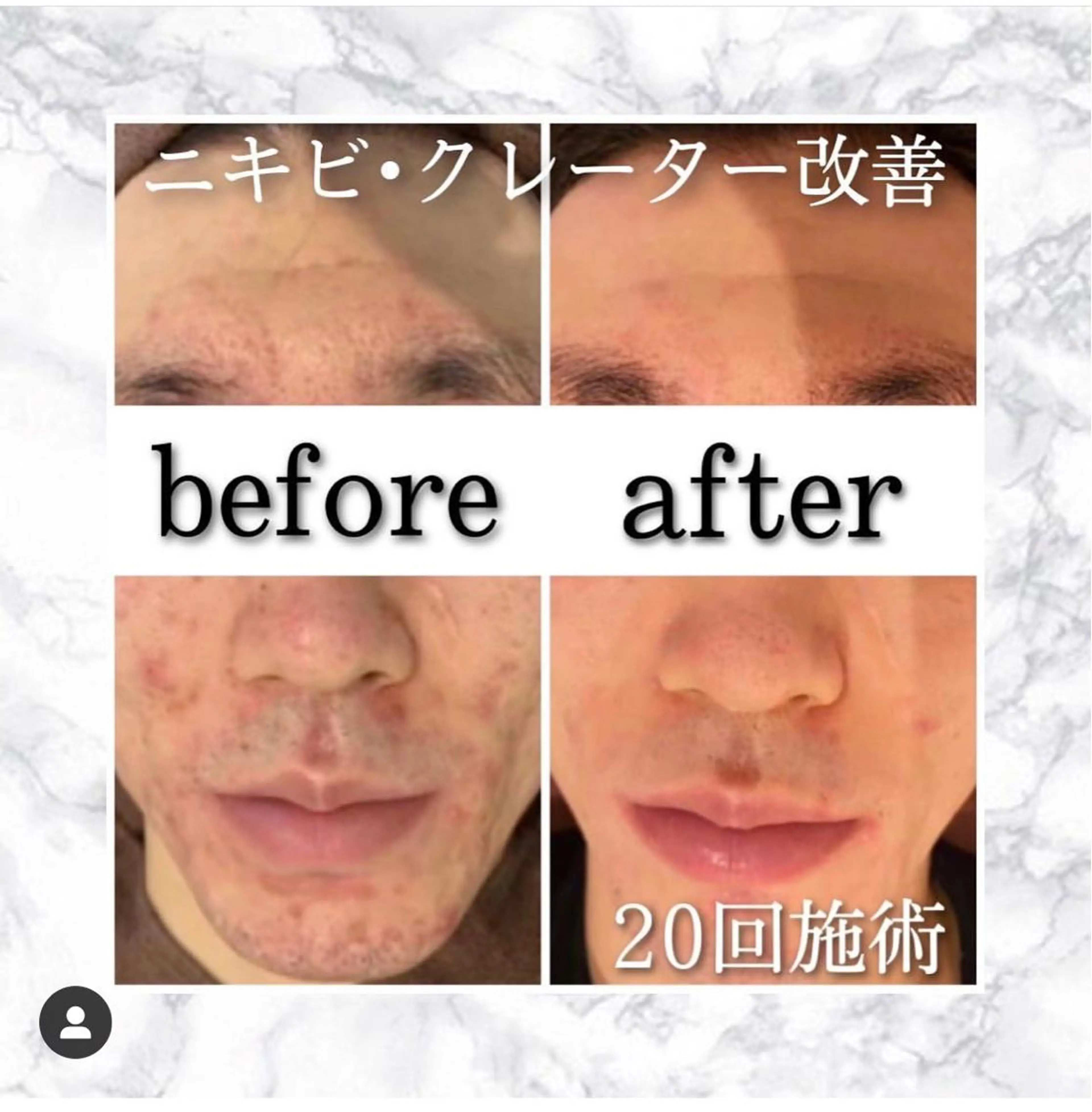 ロング カラー パーマ ヘアアレンジ メンズ キッズ ネイル マツエク・マツパ アイブロウ エステ リラク ニキビ特化型エステ 🍋最短で肌質改善のエステ・リラクイメージ