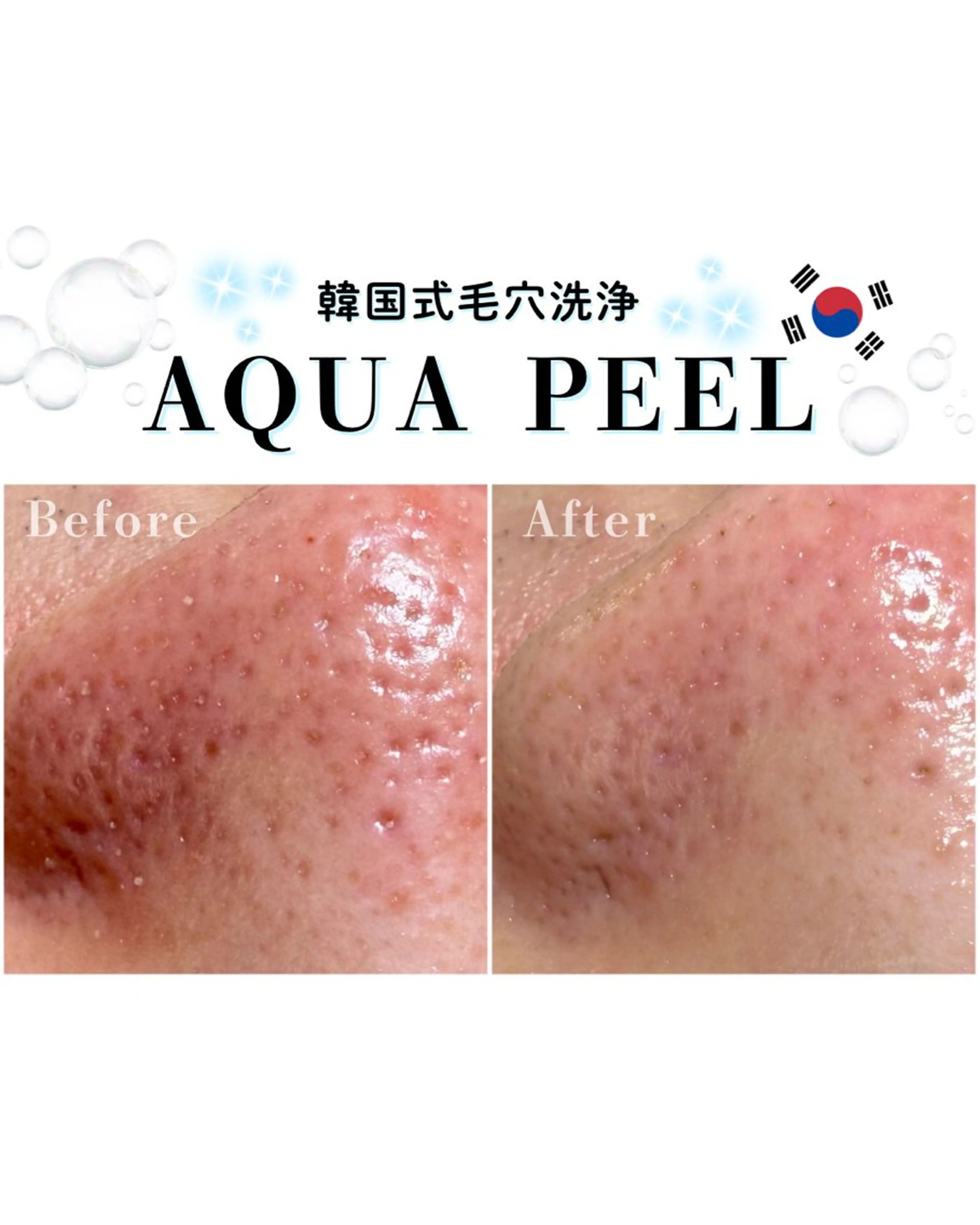 【肌荒れ/毛穴汚れ】韓国式毛穴洗浄*AQUA PEEL&水分爆弾肌管理🫧🩵慢性的な肌荒れのお悩みの方にもオススメ✨の写真