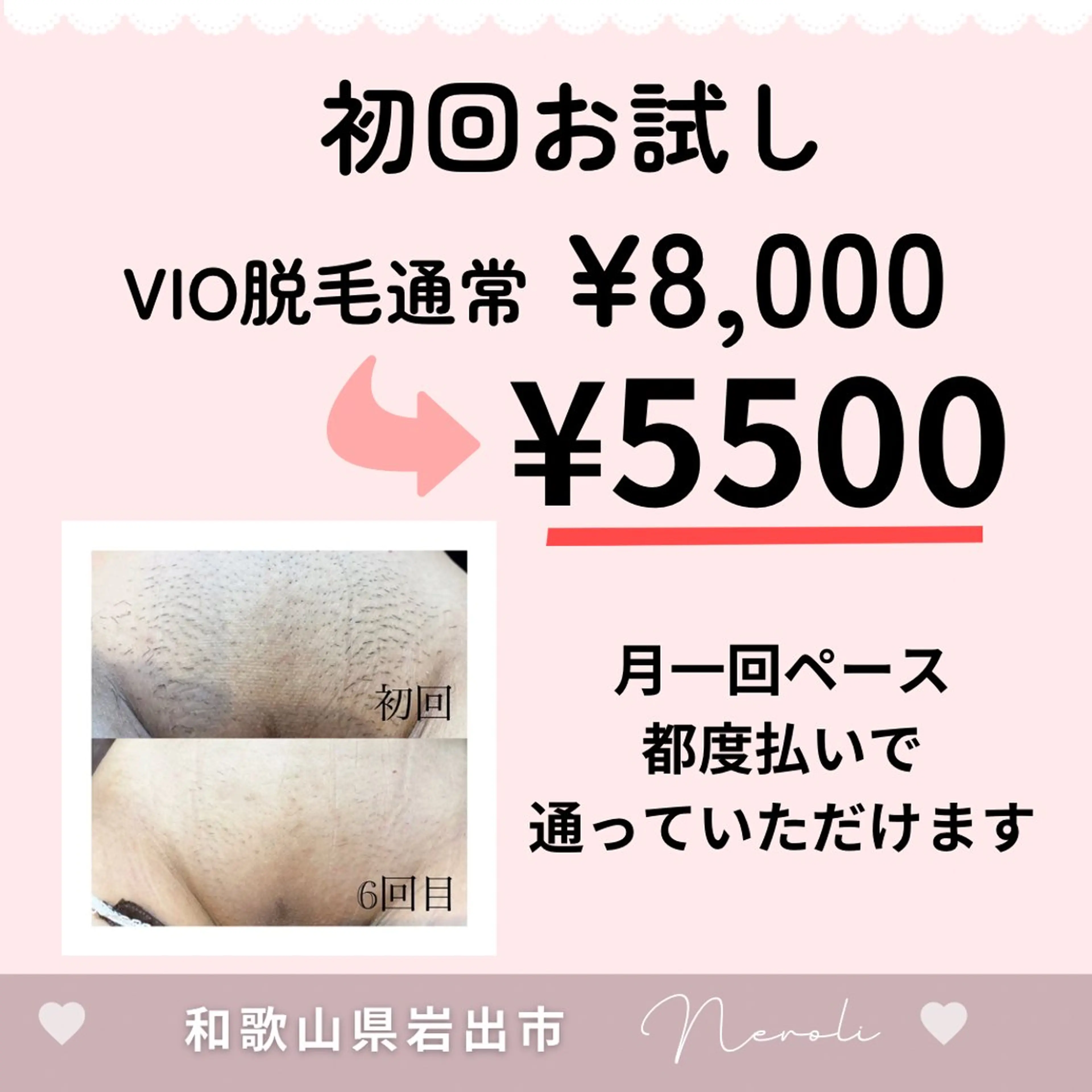 【VIO脱毛】まるごとVIO脱毛☆黒ずみ/蒸れ/毛穴/スッキリつるつる清潔感up!の写真