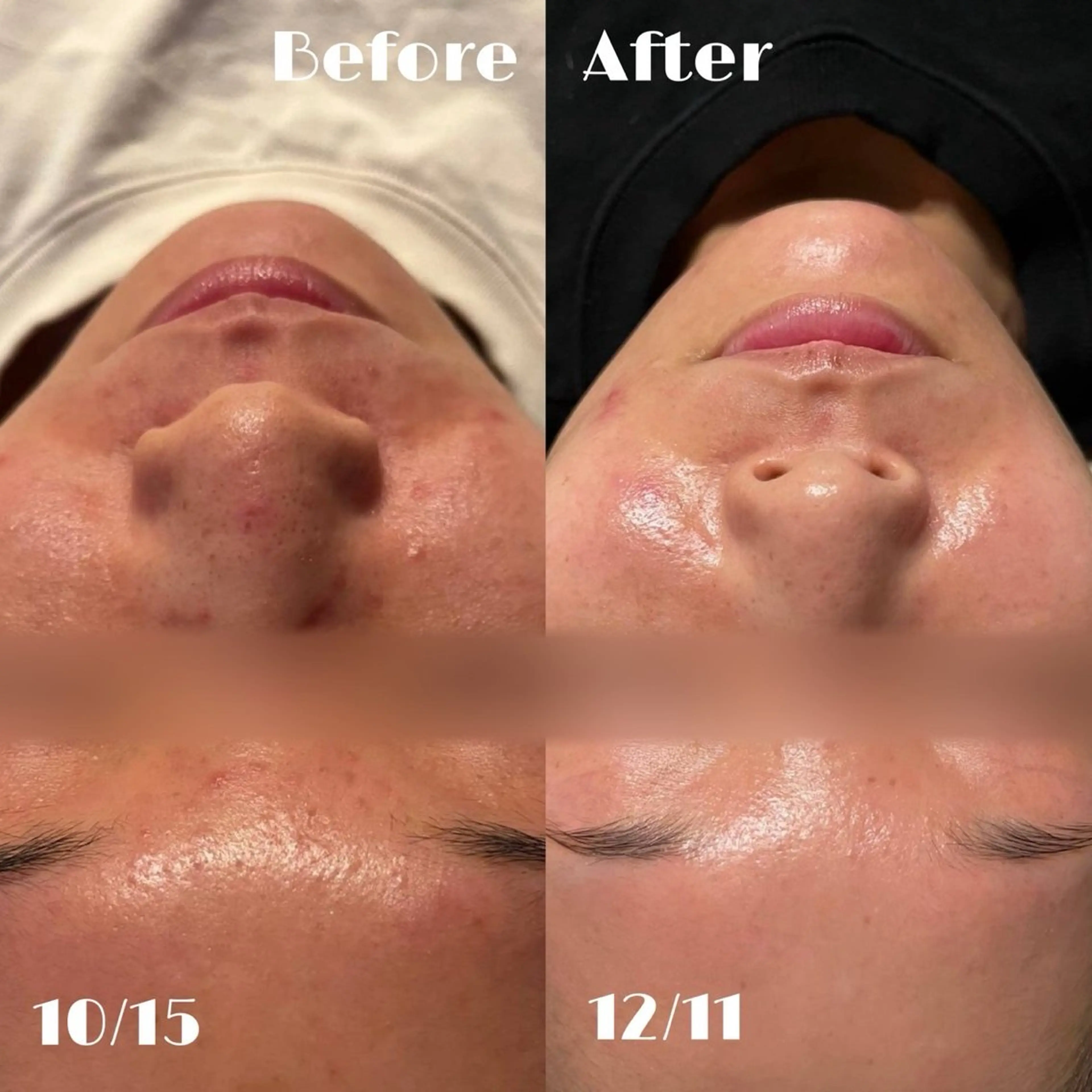 【4月限定！先着10名のみ‼️ごっそり毛穴撃退】毛穴洗浄の写真