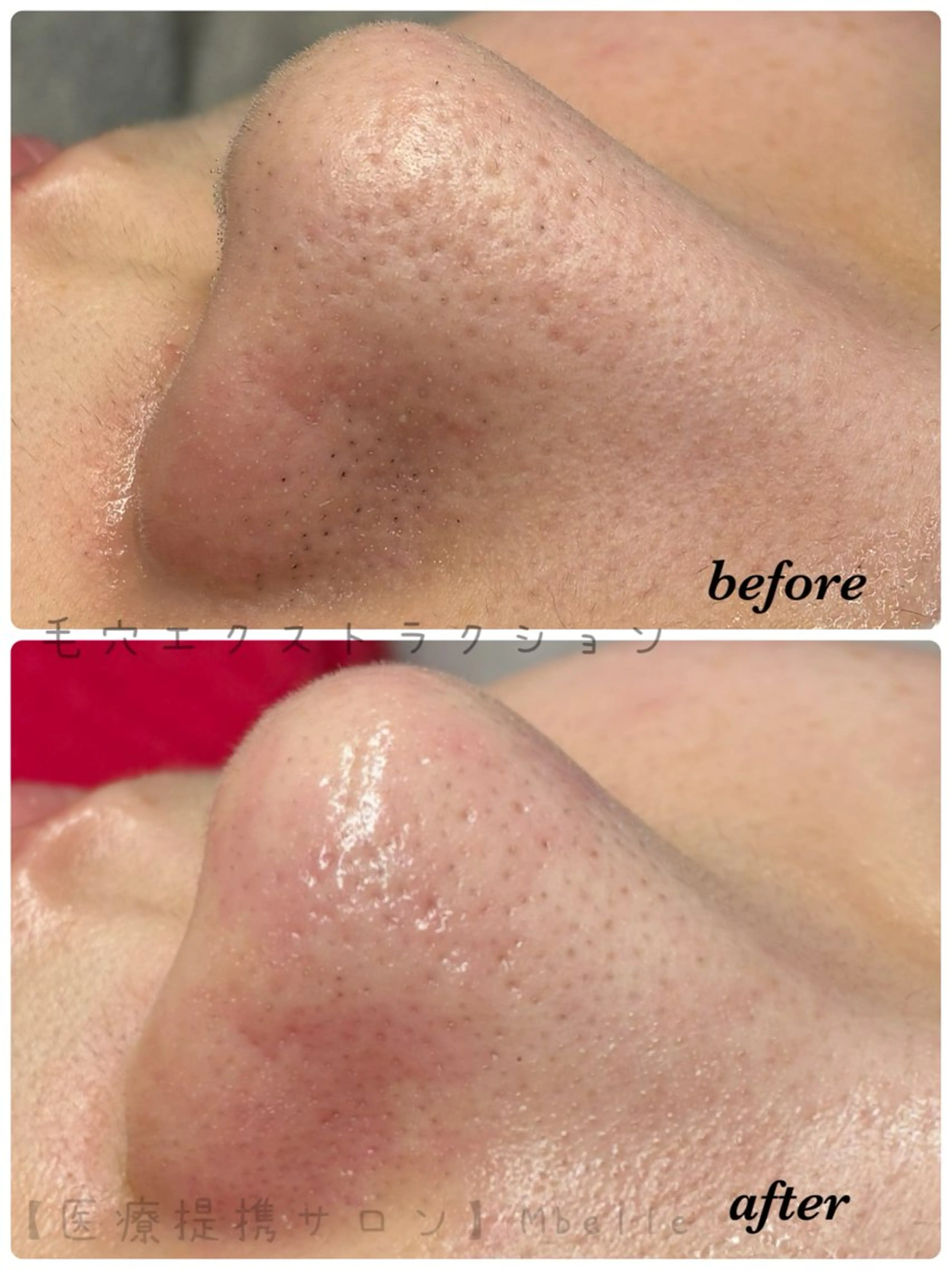 肌質改善Mbelle 越谷レイクタウン🌿のエステ・リラクイメージ