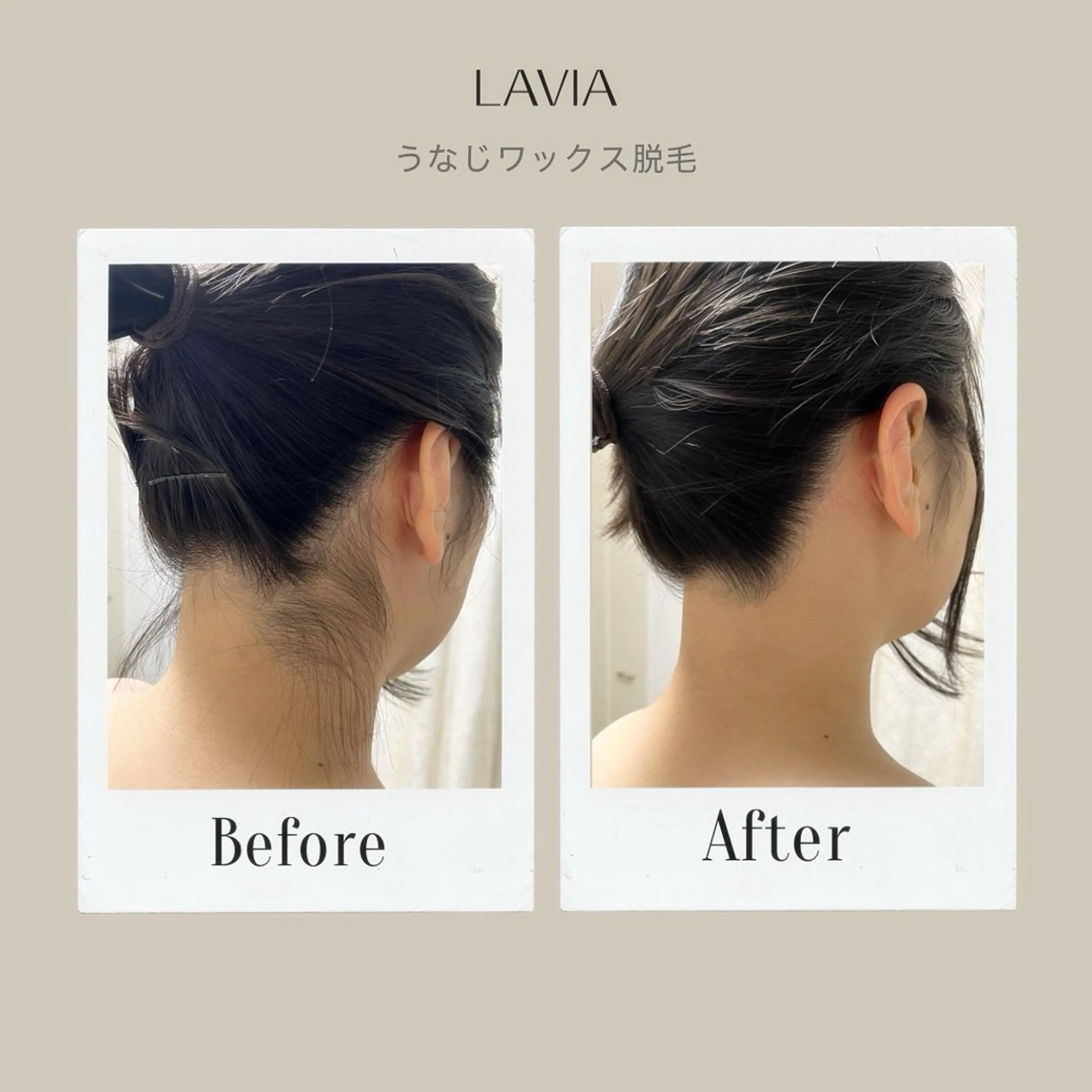 うなじワックス脱毛の写真