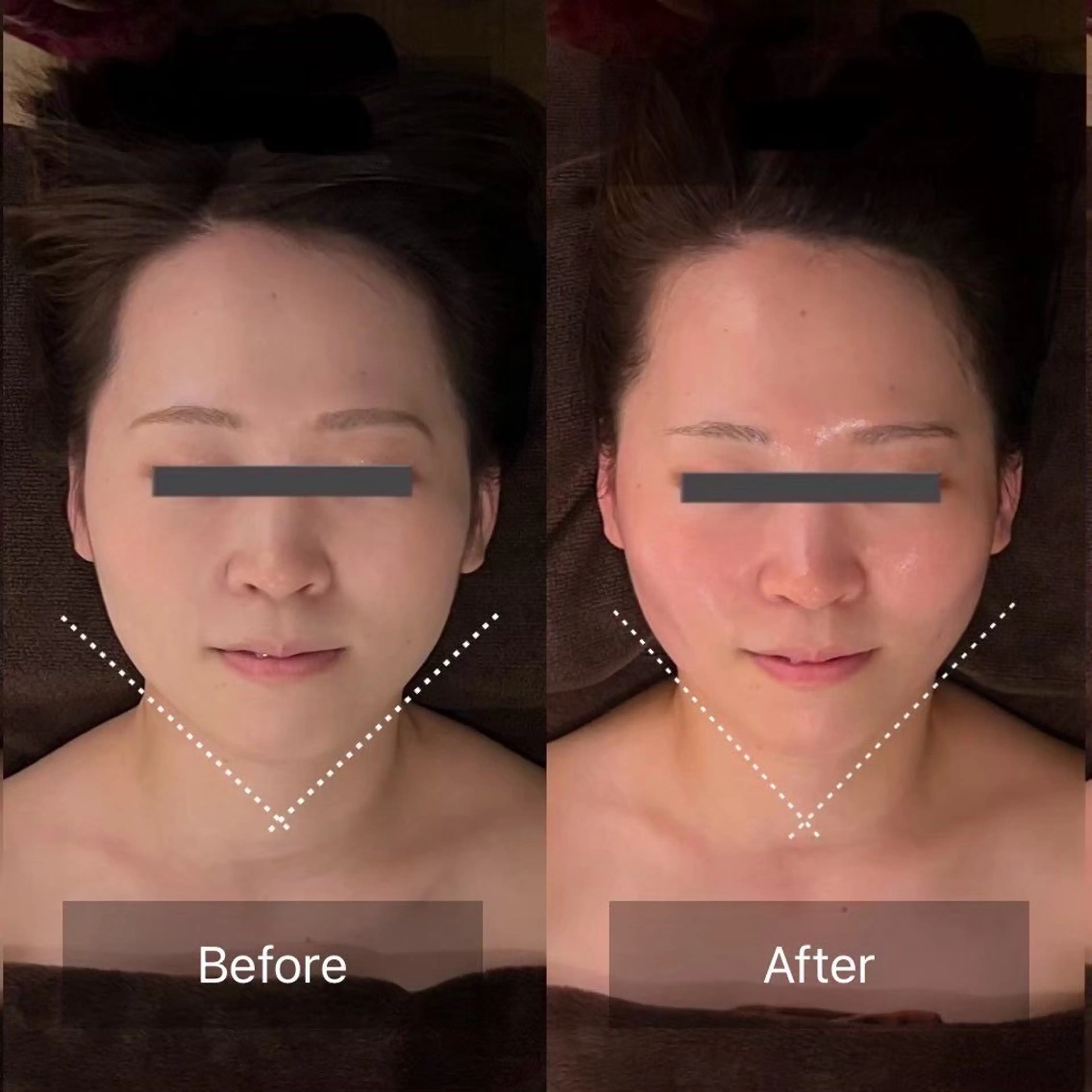 【ご新規様＊凝り浮腫み】頭蓋骨小顔矯正＋超音波ケア　通常16,000円→ミニモ限定初回10,700円の写真