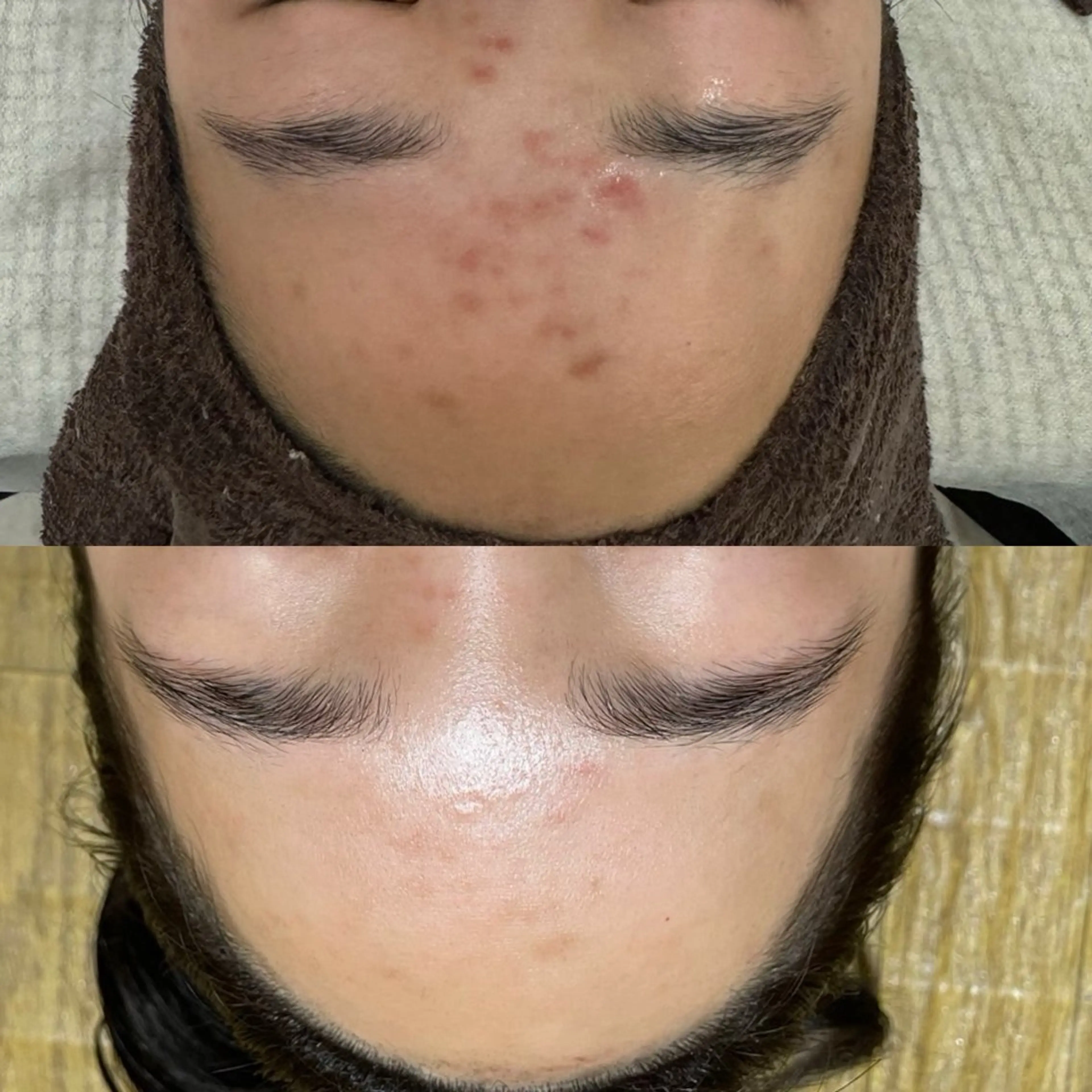 【半年後再来価格🉐】韓国式🇰🇷剥離ありハーブピーリング🌿の写真