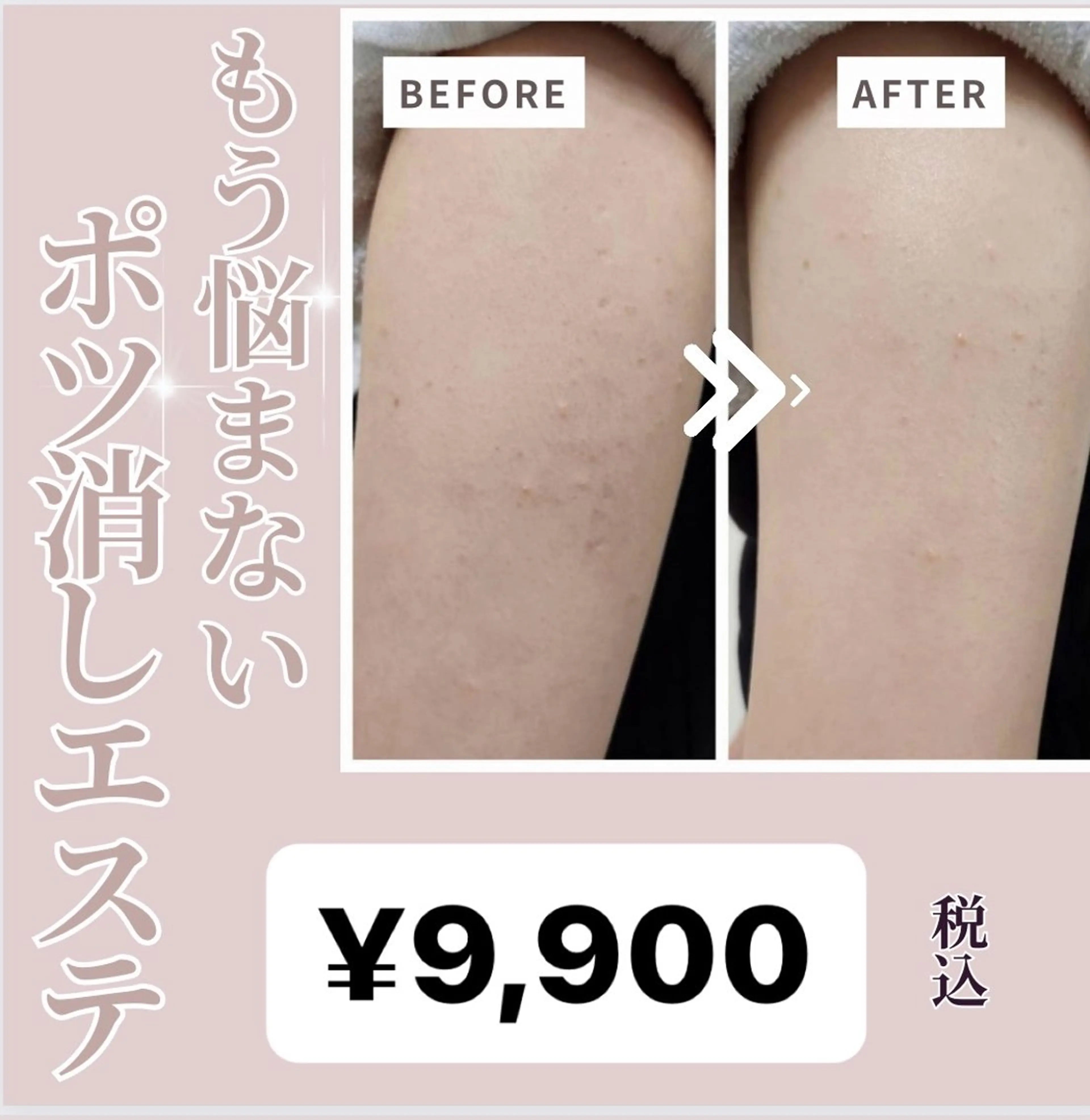 夏が来る前に今こそ二の腕ポツ消しエステの写真