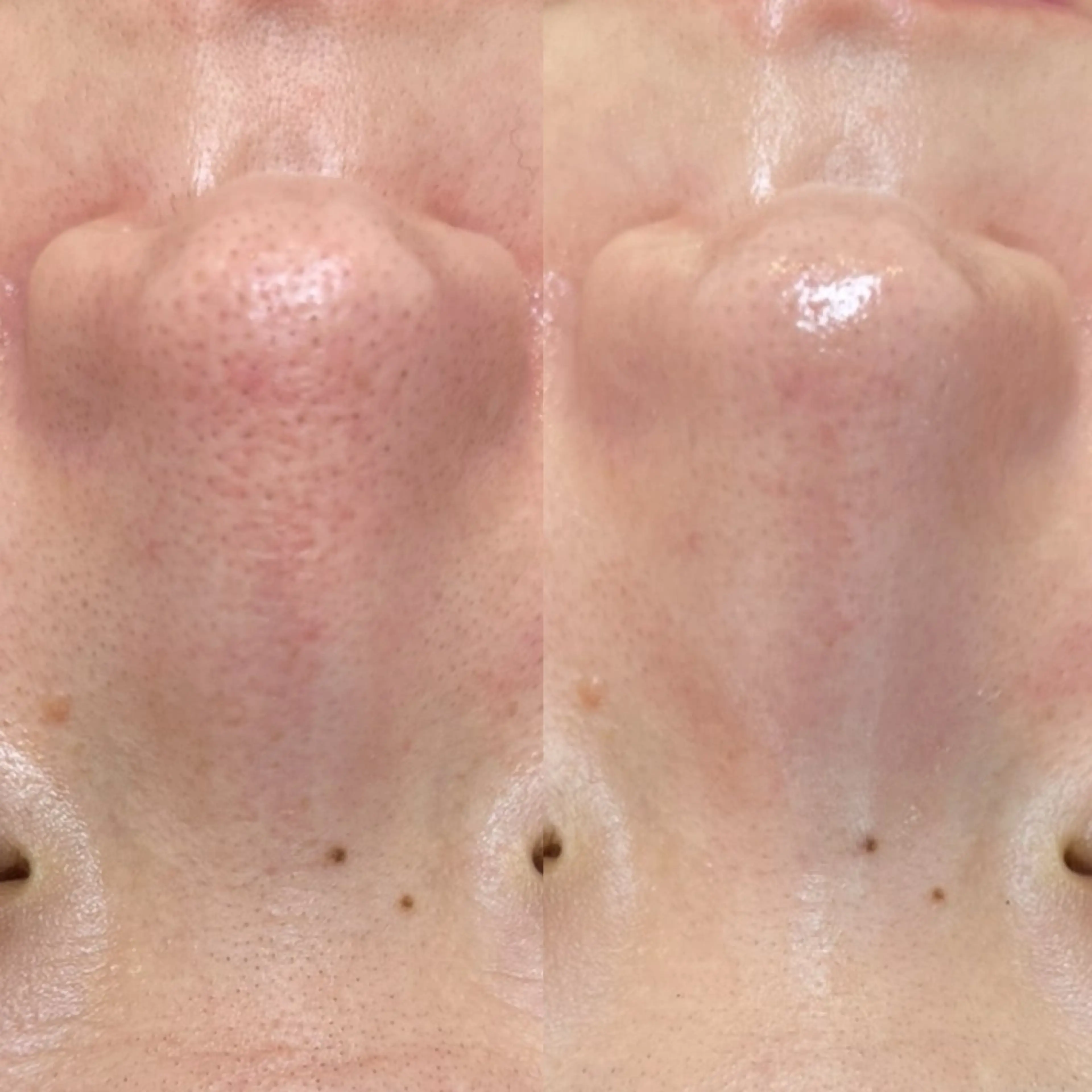 【新規】『鼻ピーリング』(小鼻の黒ずみ.毛穴ケアに◎】ハーブピーリング(鼻)の写真