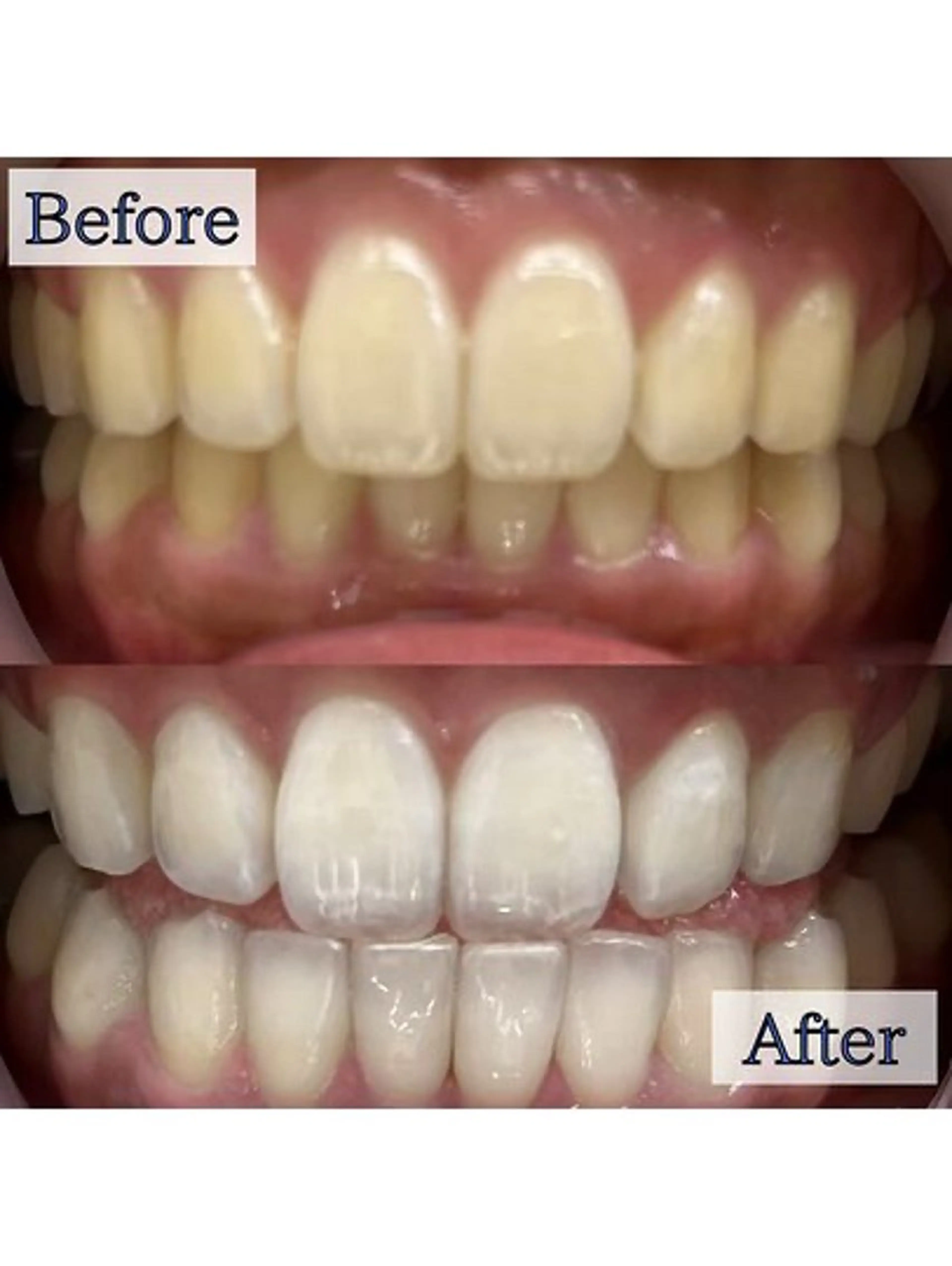 【❤️🔥1日で効果を実感したい方❤️🔥】5分照射×6回🦷照射パワーが通常の約2倍の最新セルフホワイトニング🎶の写真