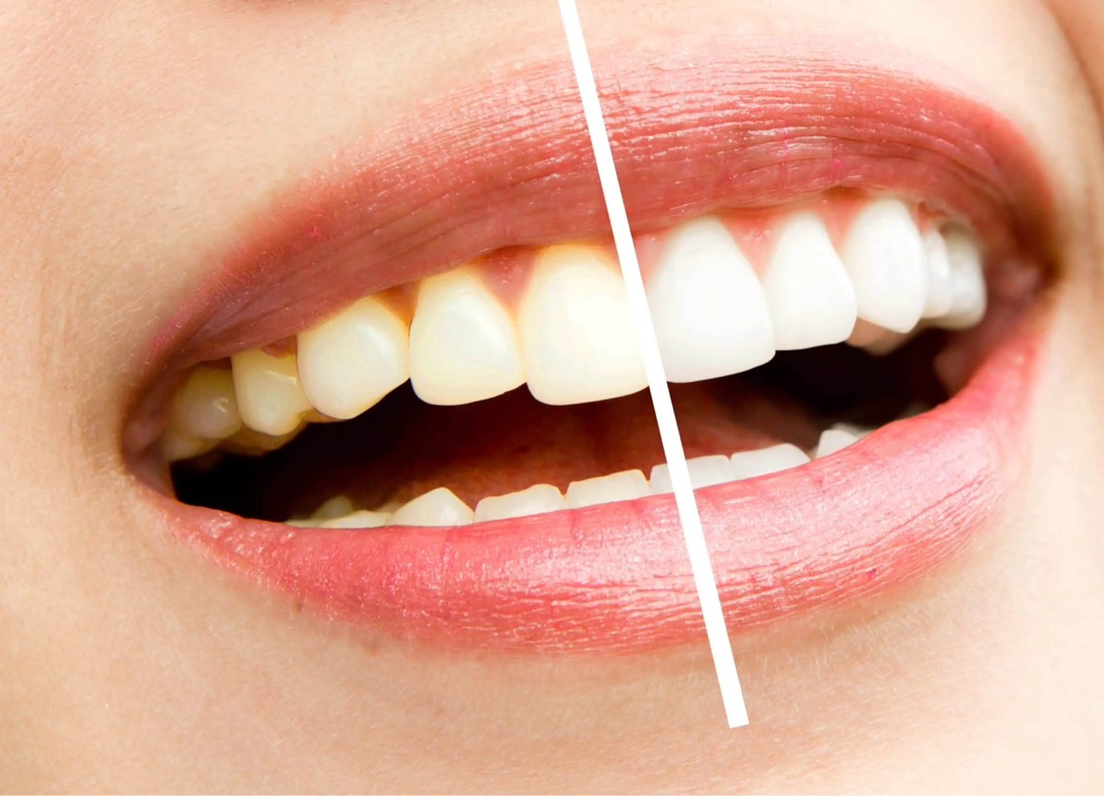 セルフホワイトニング10分×3回照射 白い歯で笑顔に自信を✨の写真