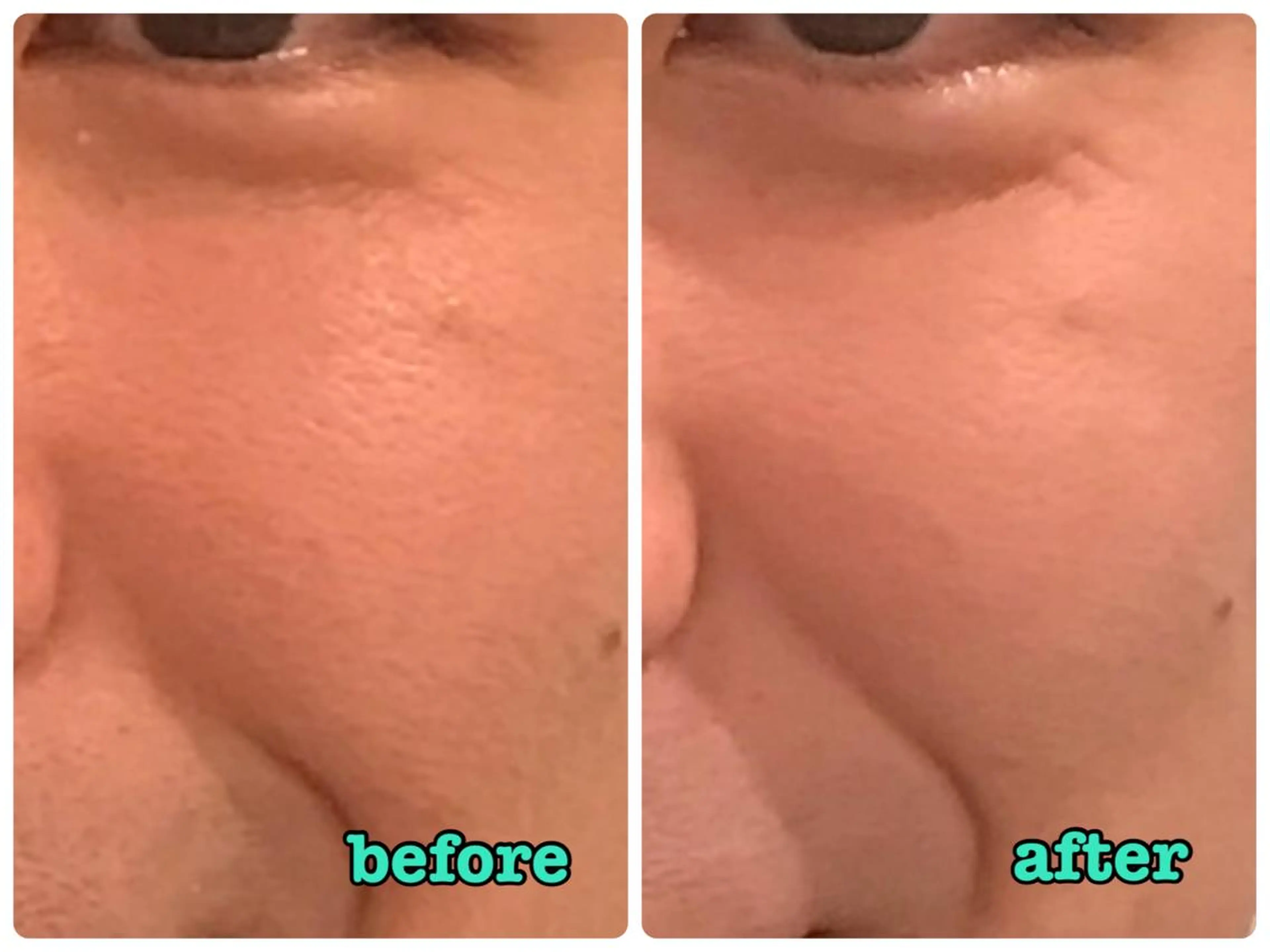 透明感アップ⤴︎✨『美白エステ』の写真