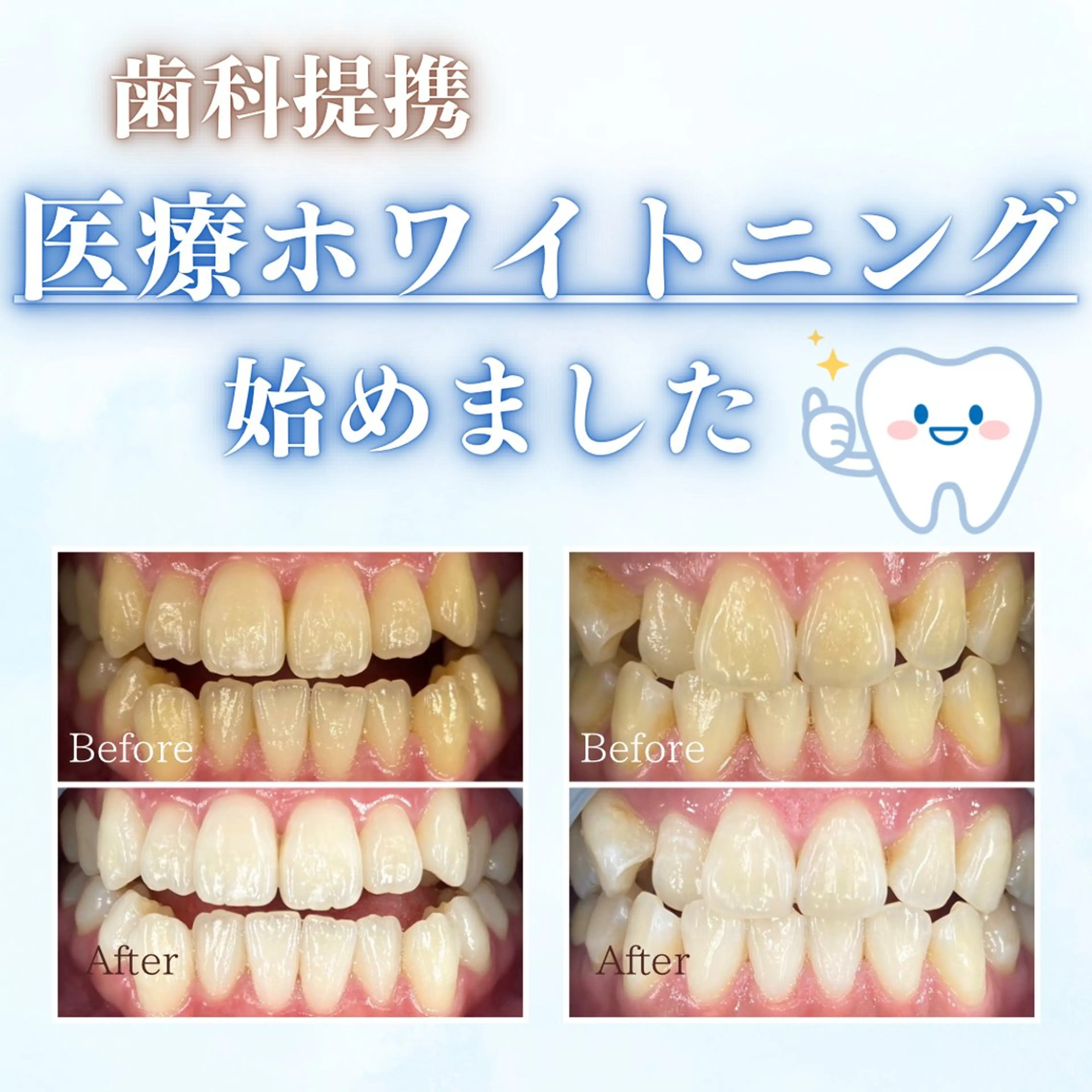 医療系セルフホワイトニング導入キャンペーン🦷✨8回チケット※別途ホワイトニングジェル代がかかります。の写真