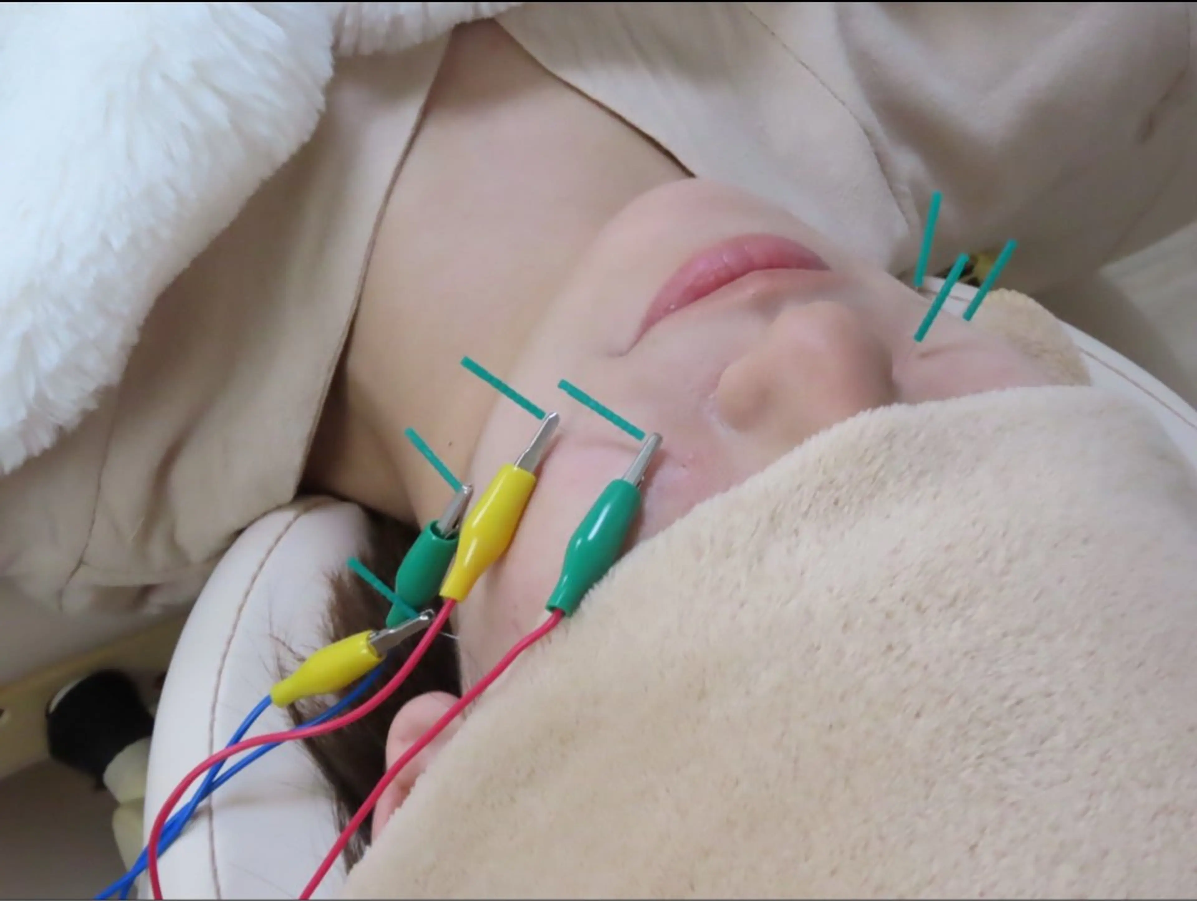 お試し電気美容鍼 ¥2500の写真