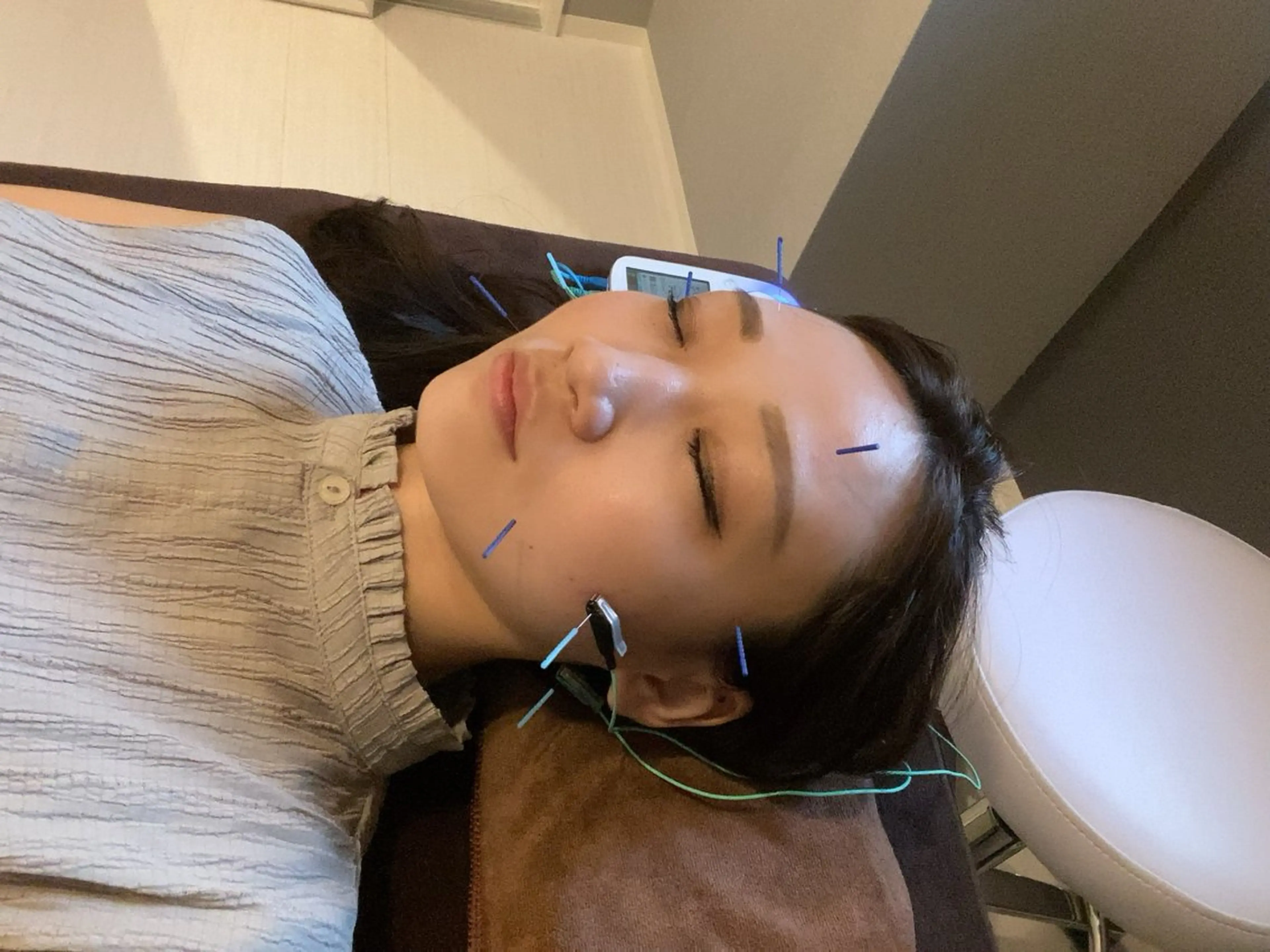 電気を流す美容鍼＋お悩みに合わせたオプションの写真