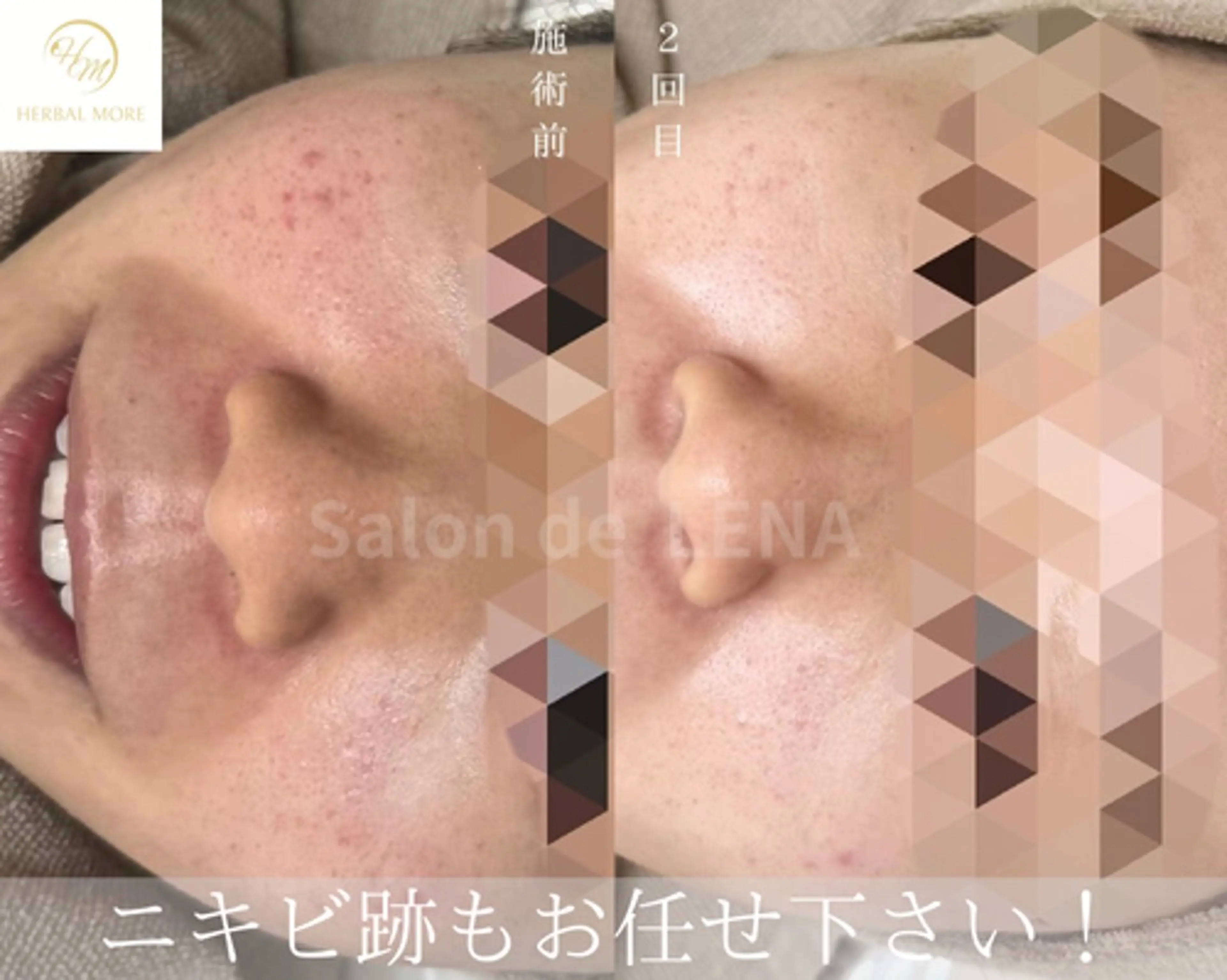 エステ ハーブピーリング専門 サロンドレナ平岡のエステ・リラクイメージ