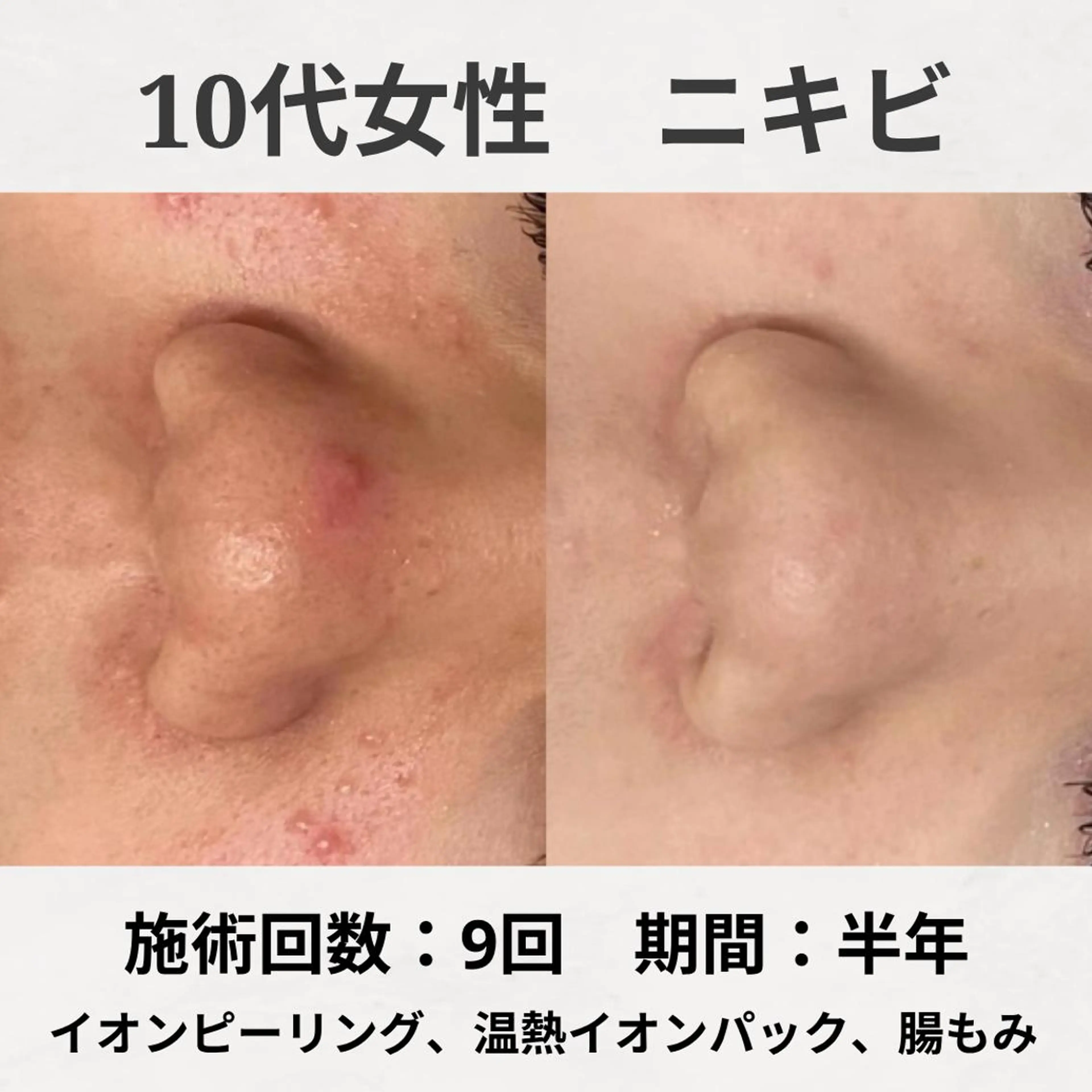 学生限定《皮膚科通いの方🏥》薬を止めると出てくるニキビ😭からの解放🌸集中ケアパックで根本改善で徹底アプローチ👀の写真