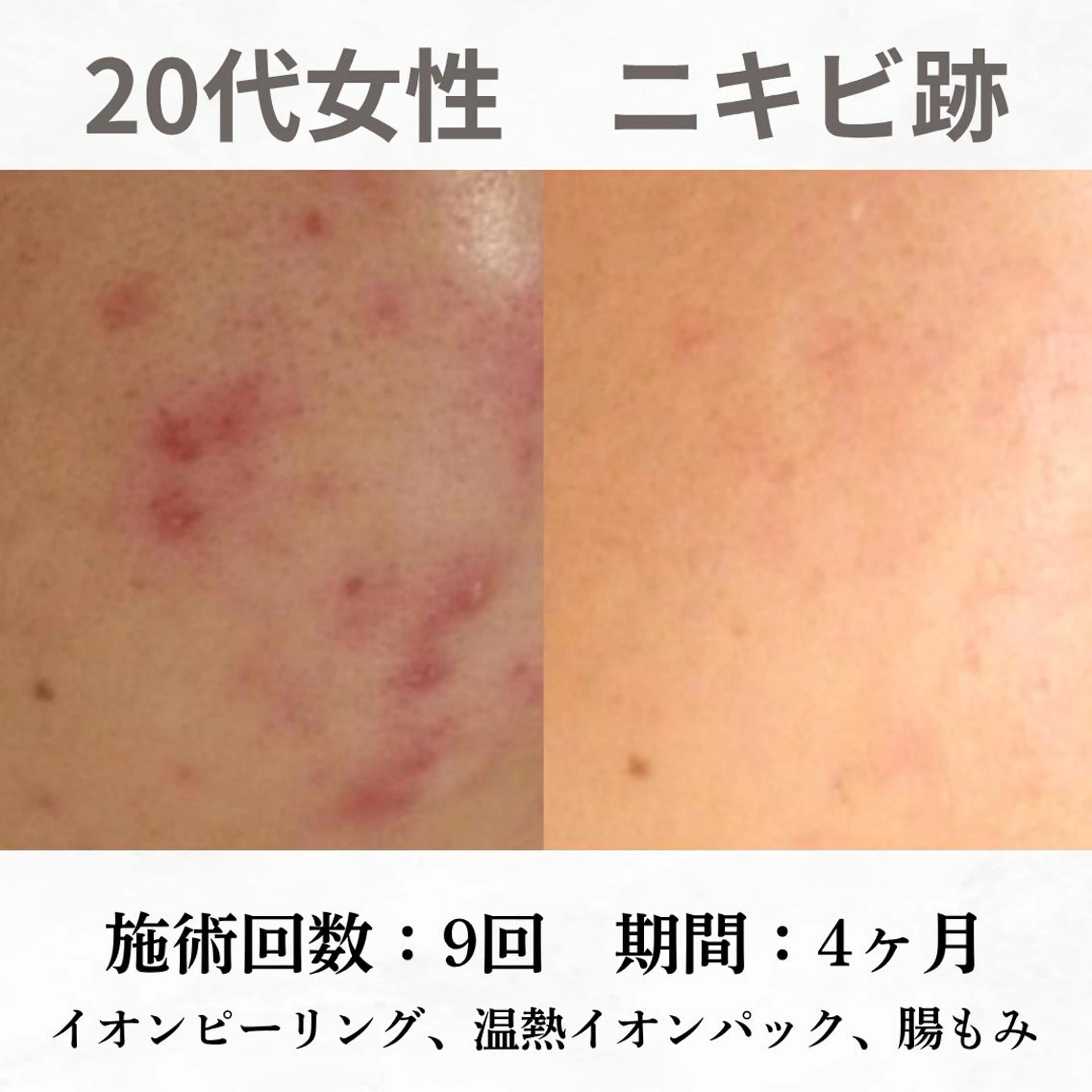 重度ニキビ専門🌷 ダウンタイムなしのエステ・リラクイメージ