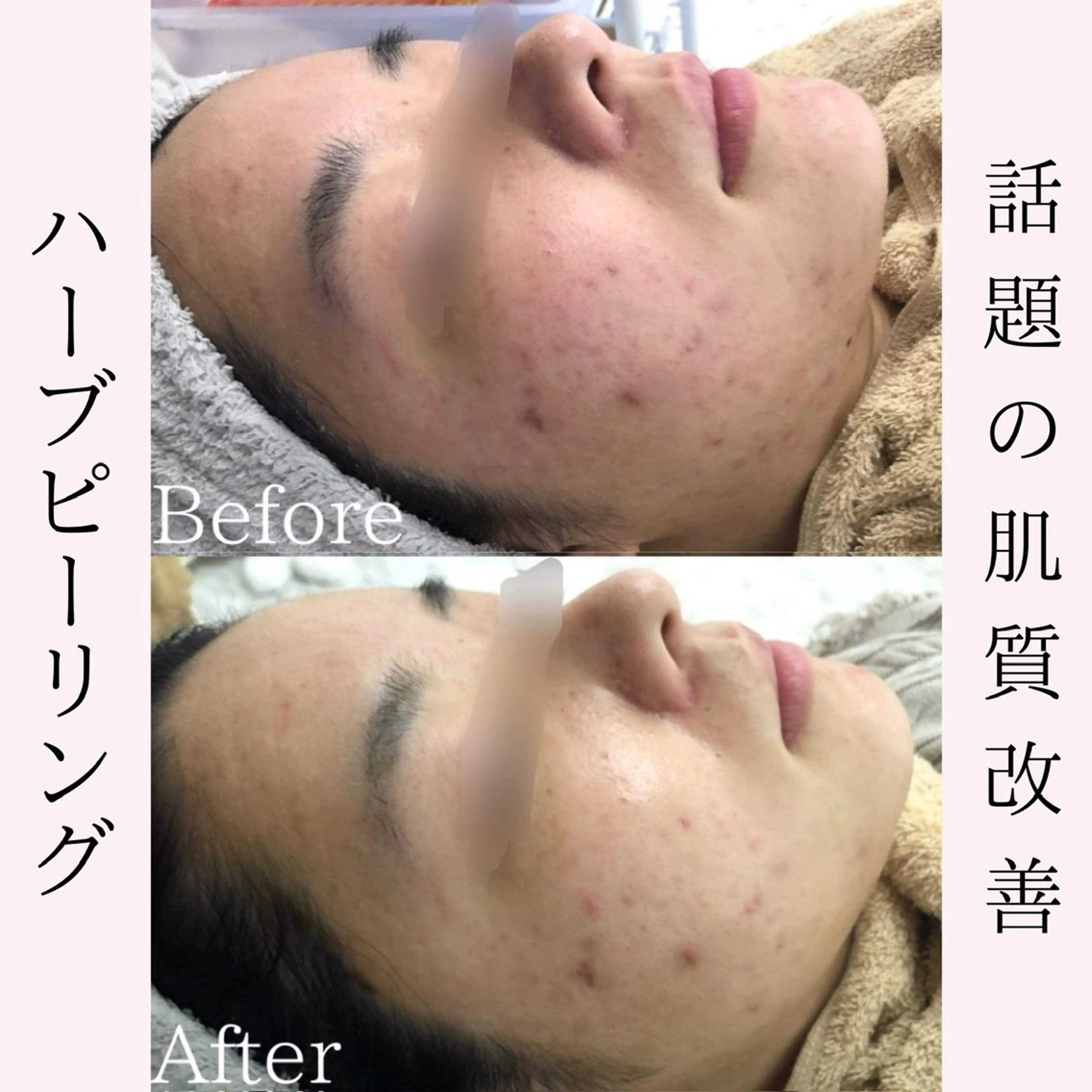 エステ BestBelleꕤ 大阪福島/肌質改善のエステ・リラクイメージ