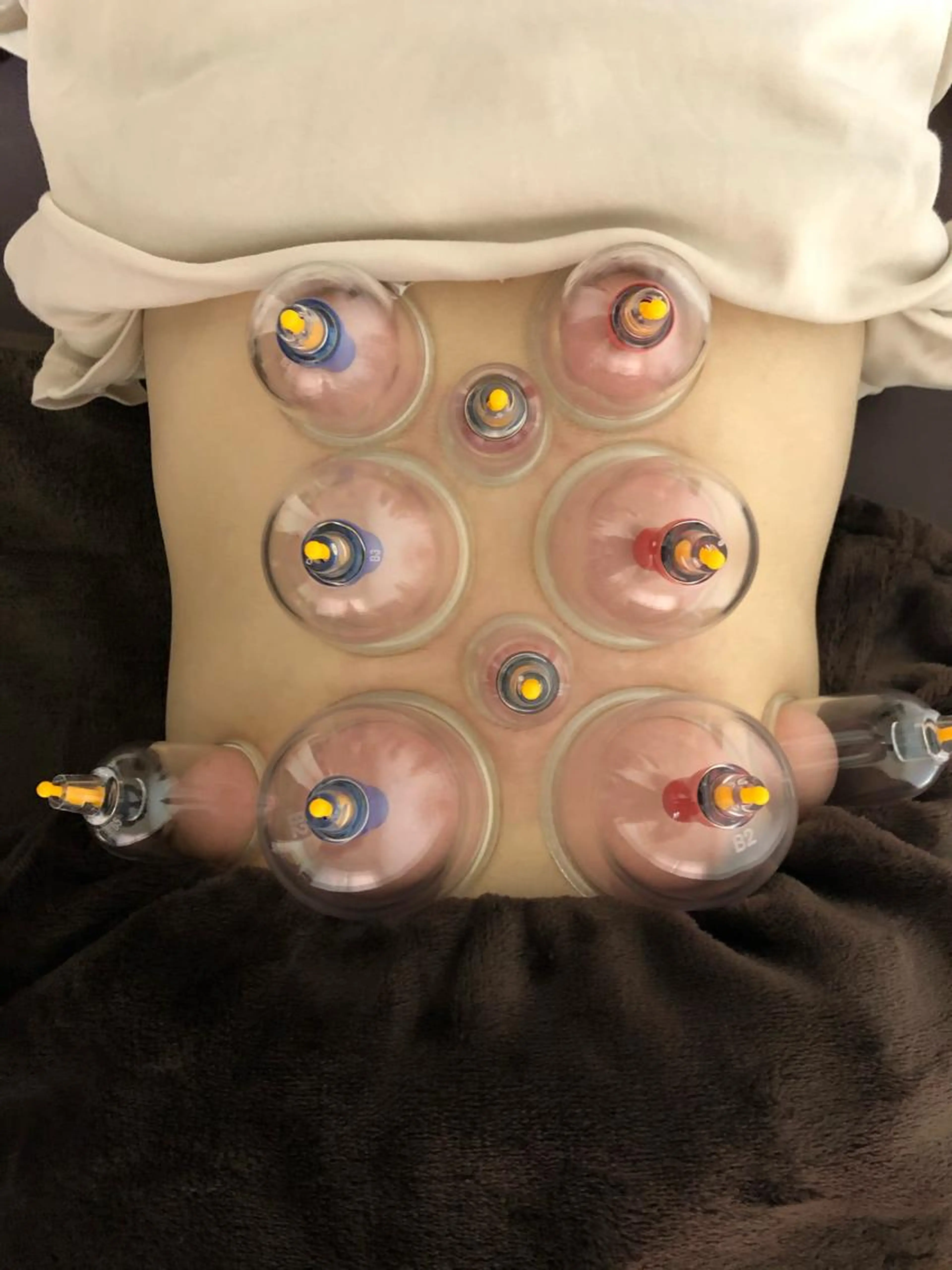 美容針＋吸玉✨吸玉で背中の血流を改善し、美容針でマイナス5歳肌を手に入れましょう🌟の写真