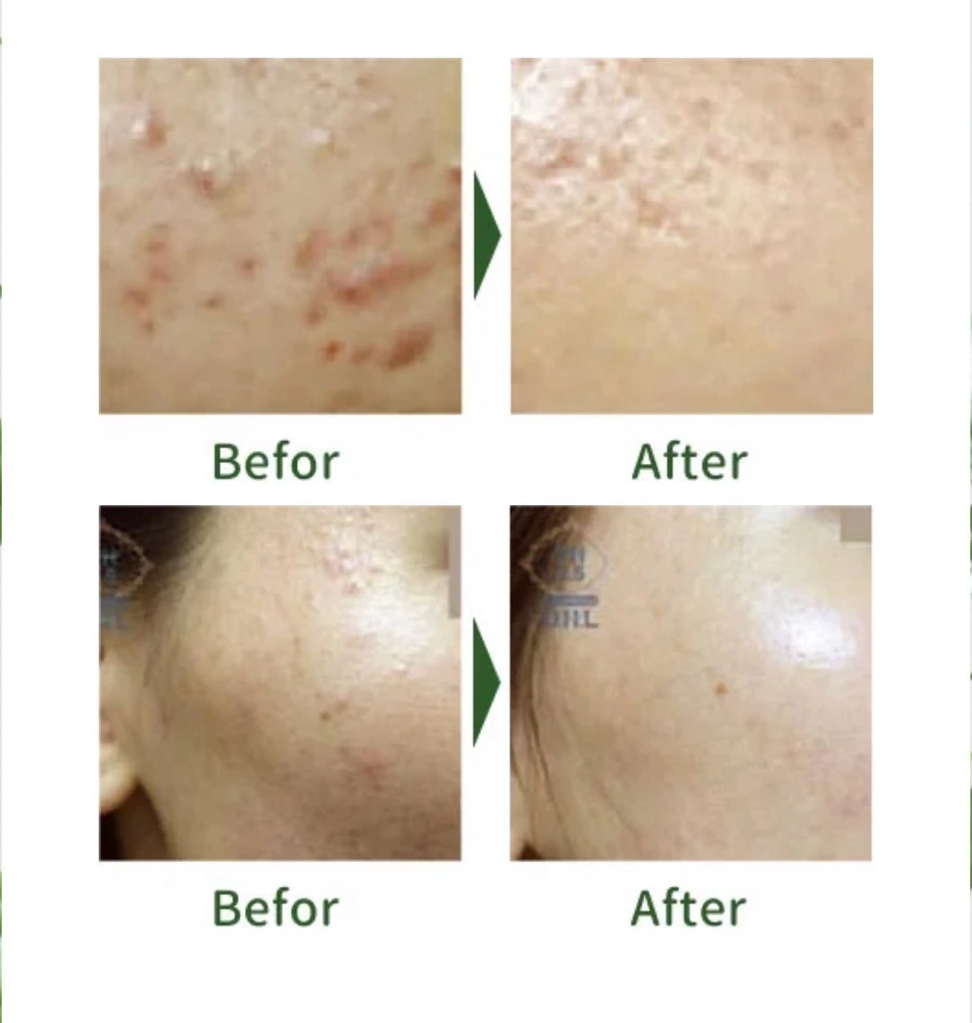 【オススメNo.1】小顔+ハーブピーリング+生コラーゲン導入+石膏パック60分の写真