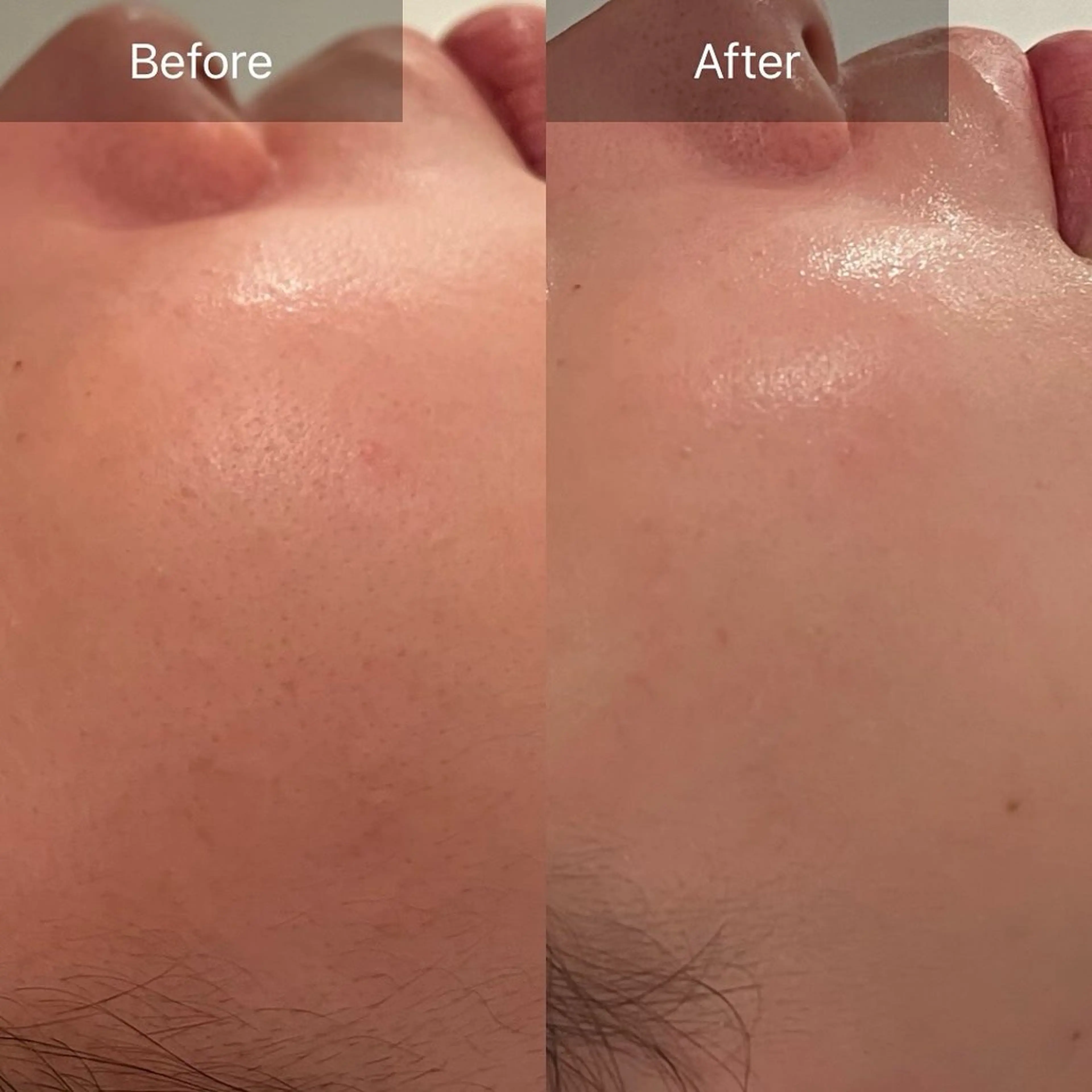 花粉/肌荒れ/ニキビケア！！肌荒れにお悩みの方はこちら💁🏼‍♀️の写真