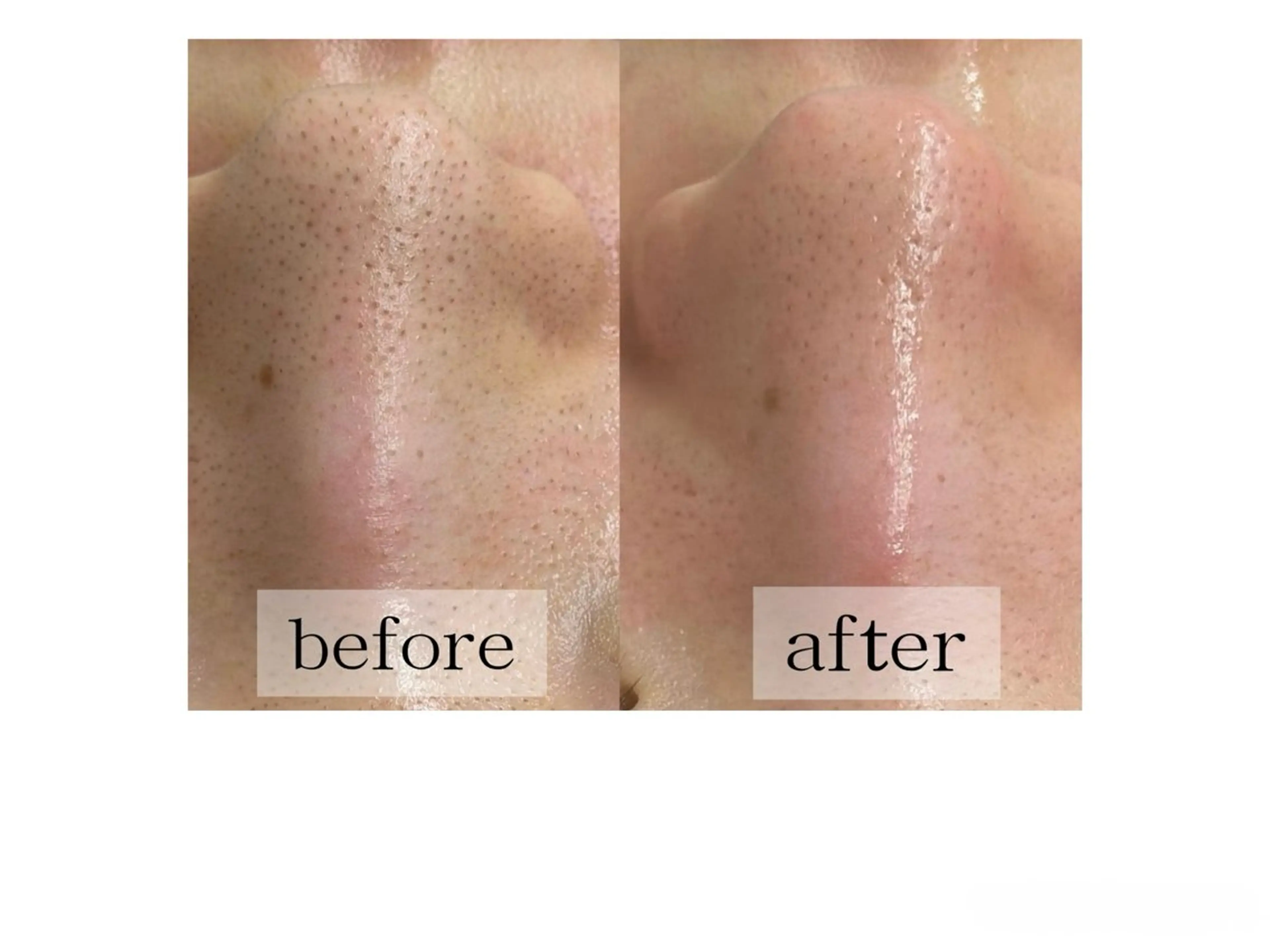 4月限定!!【毛穴欲張りメニュー】ハイドラ最新水流🚿毛穴洗浄×イオン導入×顔脱毛の写真