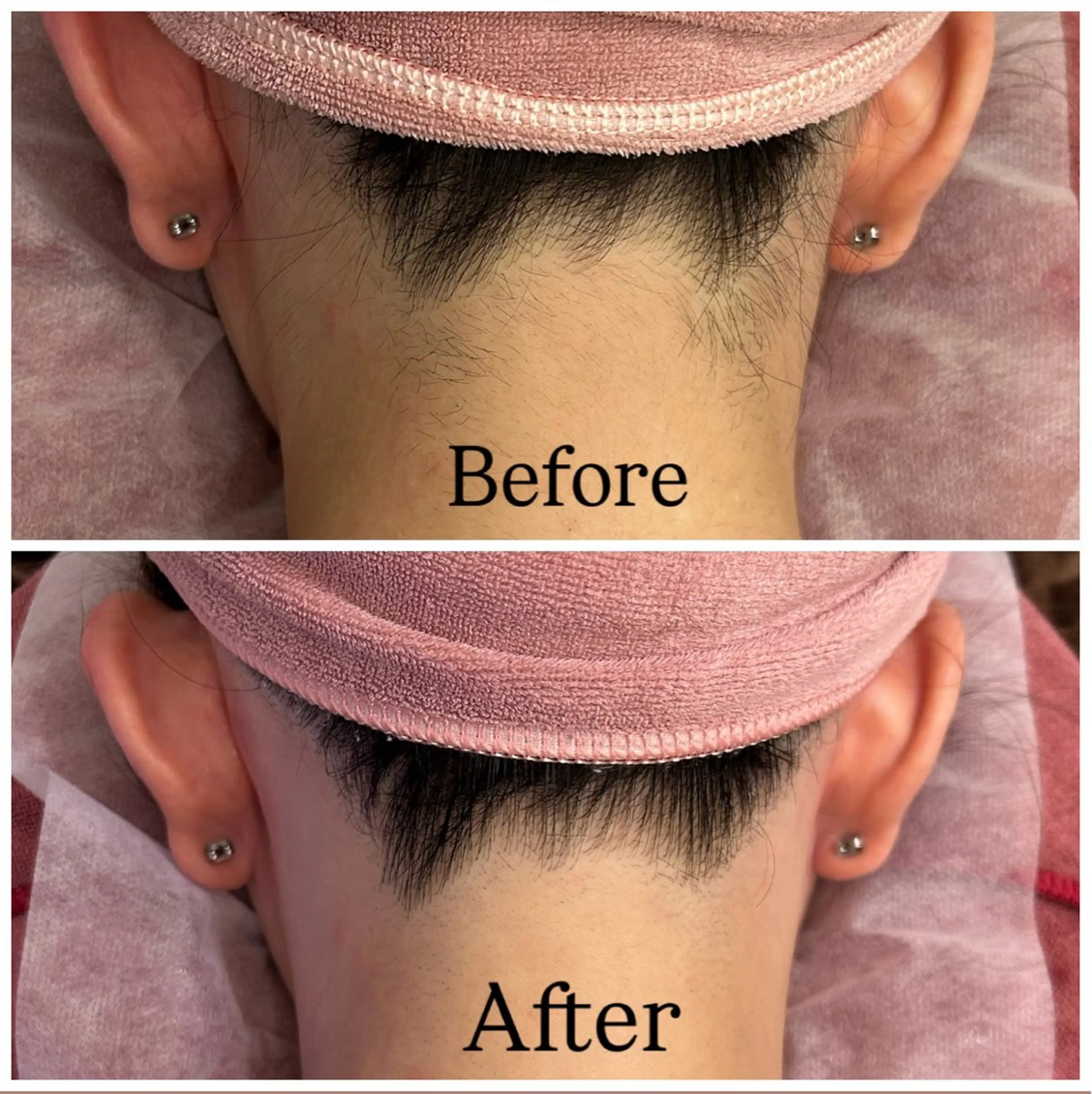 【２位🥈背中・うなじ脱毛✨¥11000→¥8000】（シェービング/角質ケア/保湿付）ご新規様限定🪽 回数：1回の写真