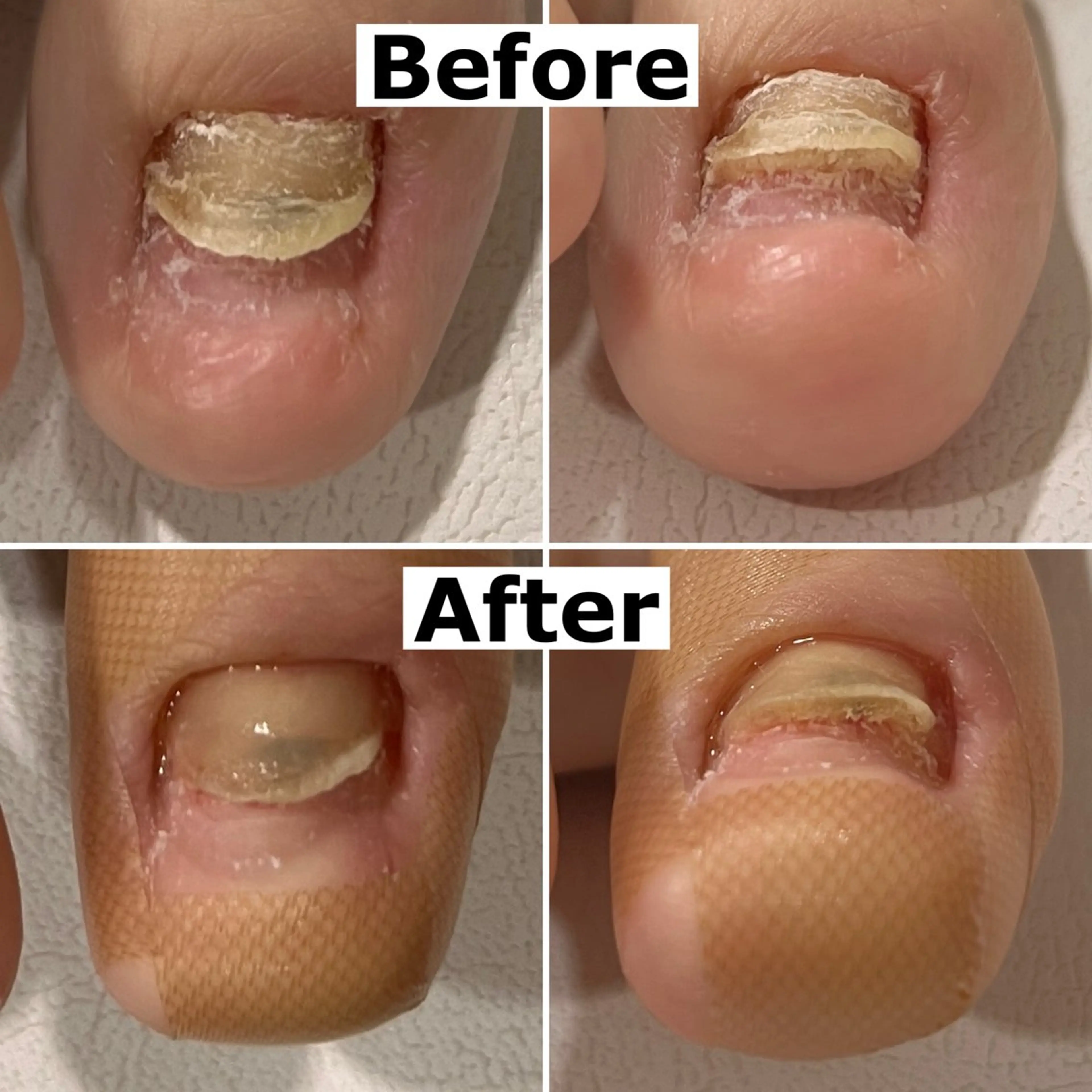 巻爪無料モデル募集 ✨🦶MEGUMIのネイルデザイン