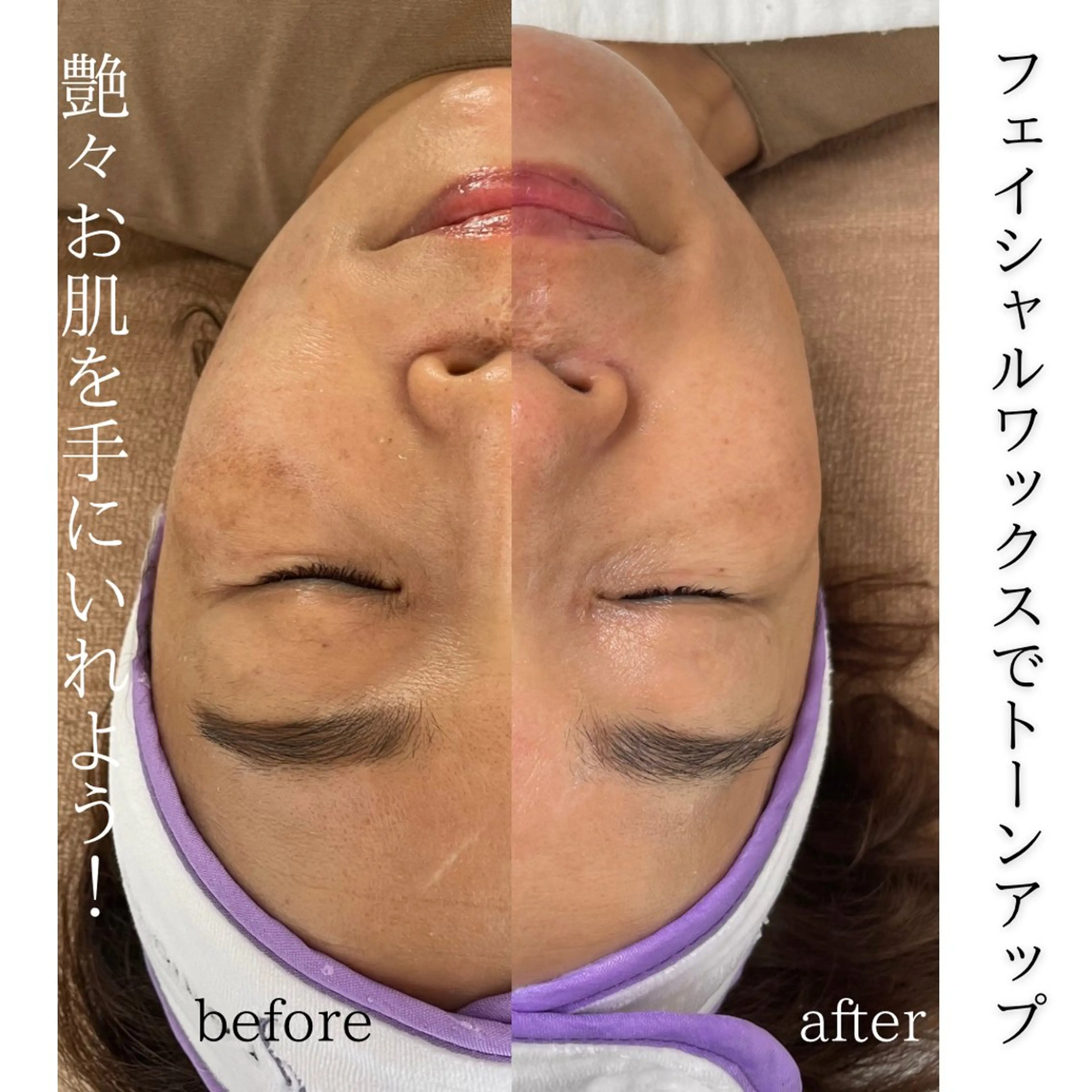 フェイシャルワックス   お顔の産毛や古い角質をワックスで除去することでトーンアップしお肌整いツヤ肌になりますの写真