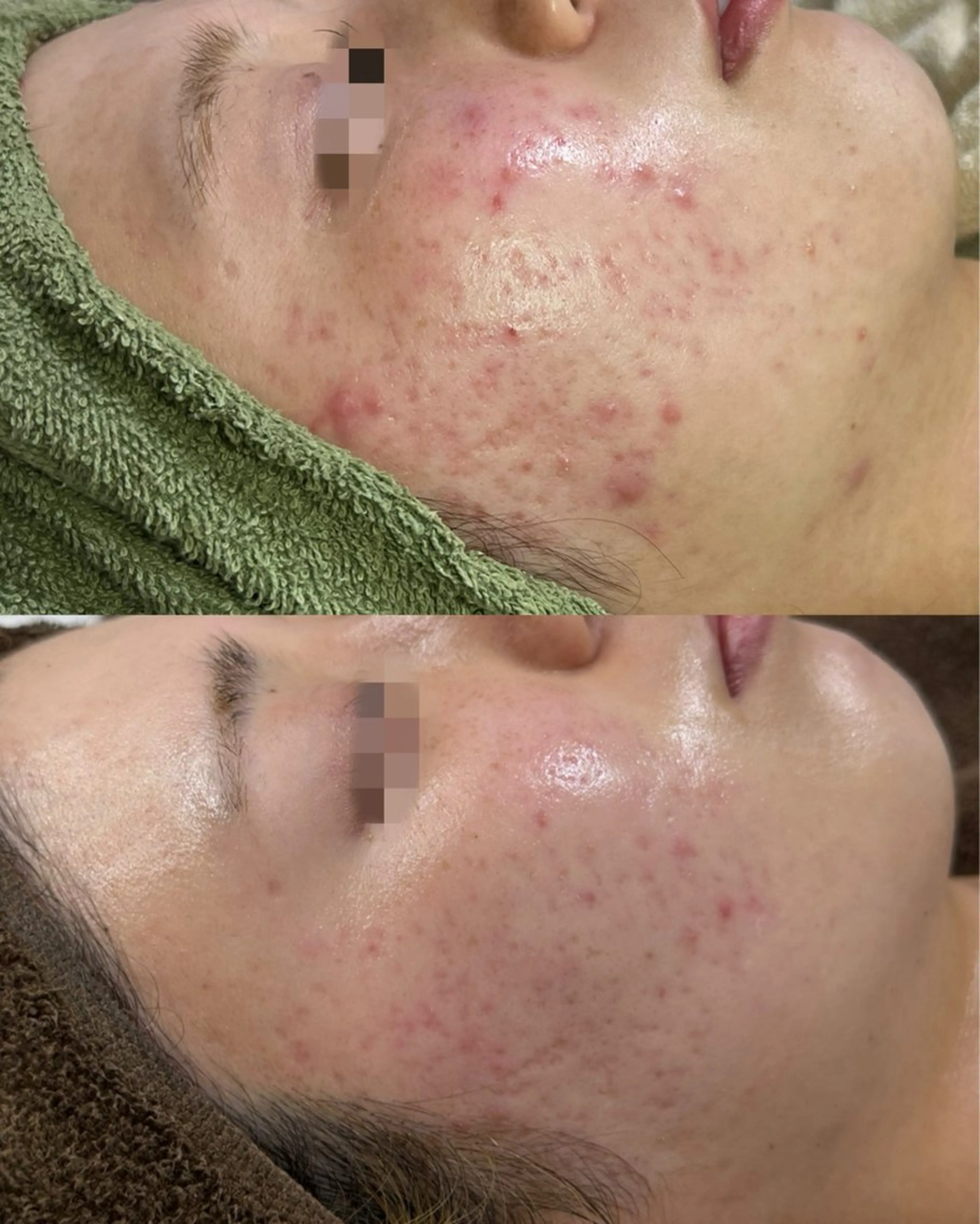 【人生最後のニキビケア】最短で改善へ🪸HAABRBPROハーブリプロの写真