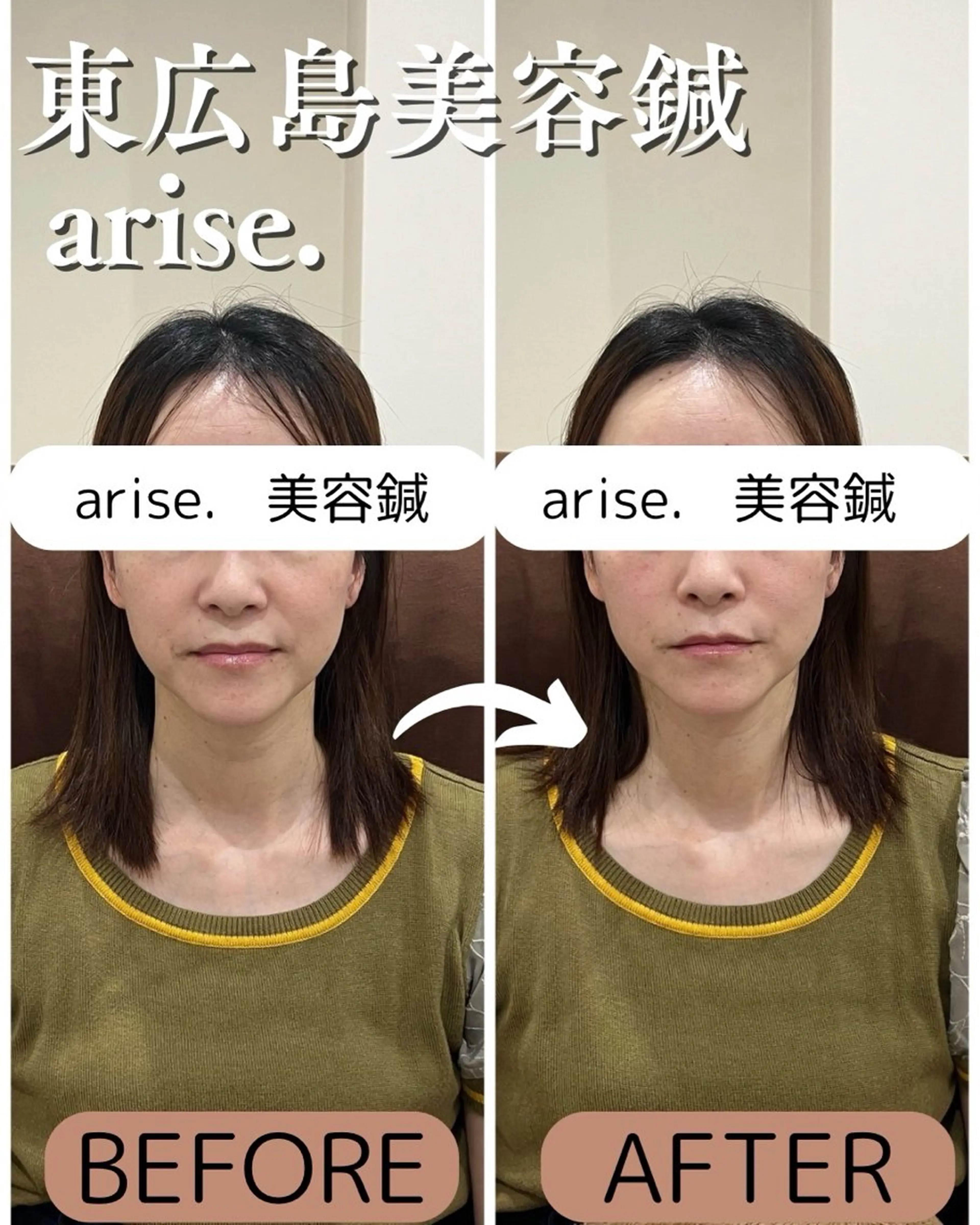 その他 東広島美容鍼 /arise.のその他イメージ