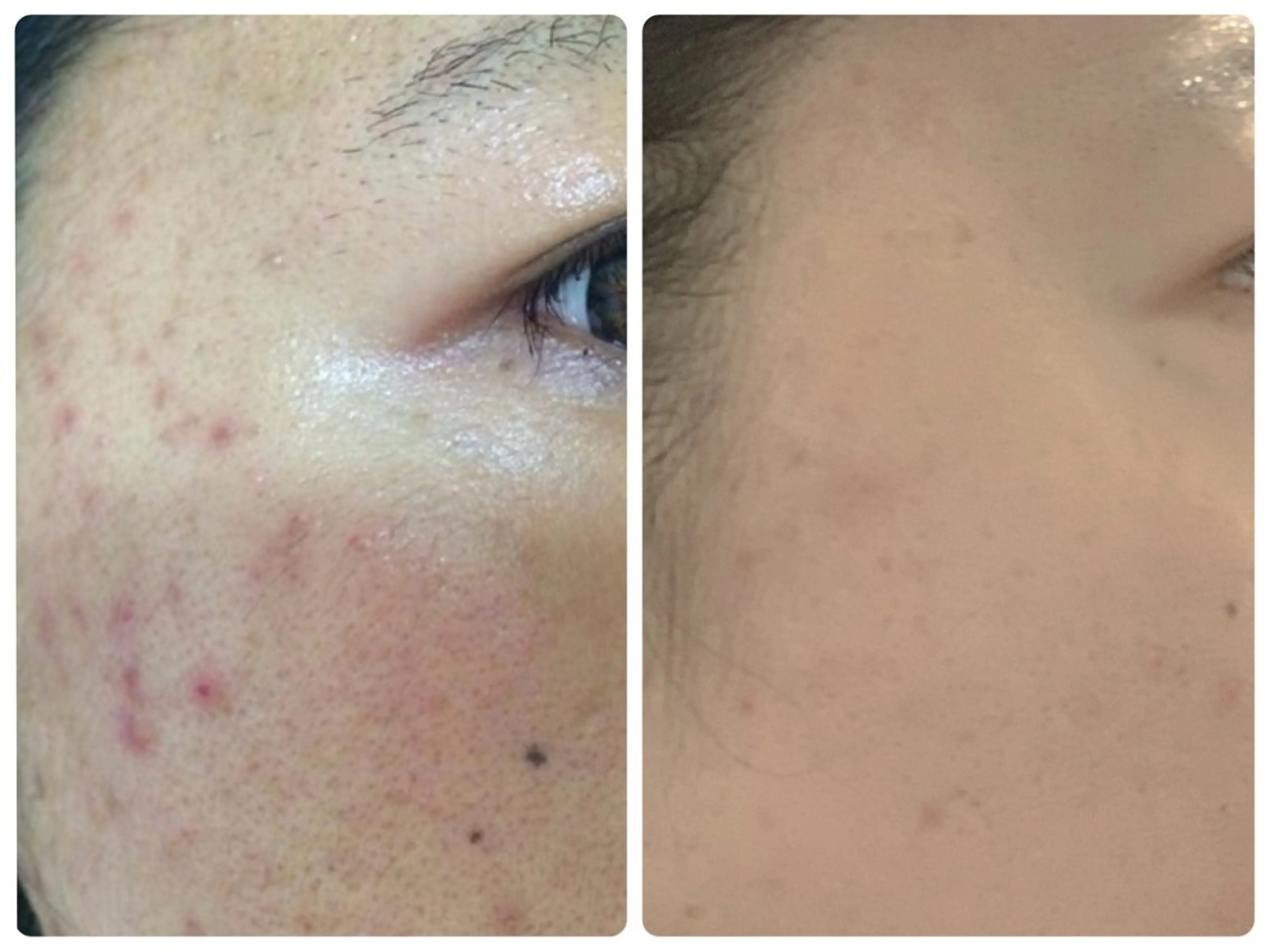 ニキビ・ 肌荒れ専門店のエステ・リラクイメージ